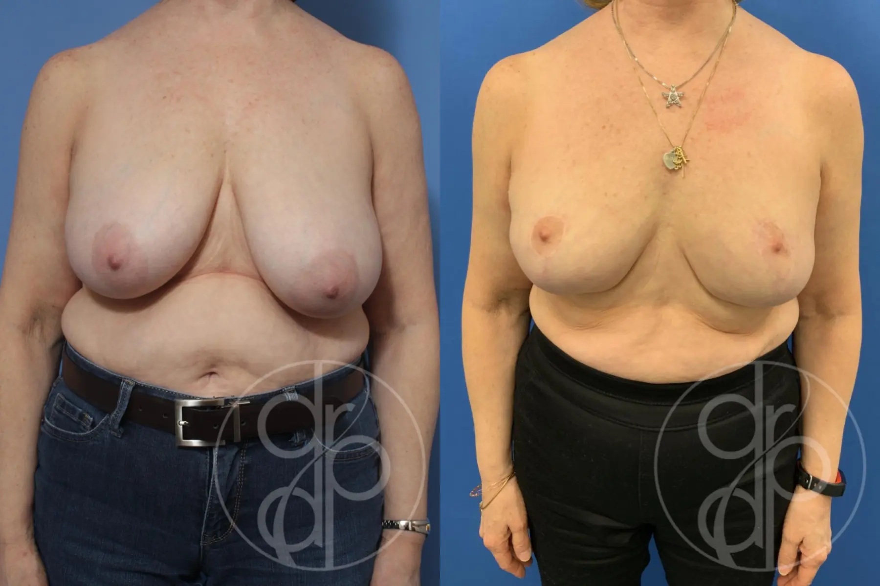 patient 10400 breast reduction before and after result - Before and After