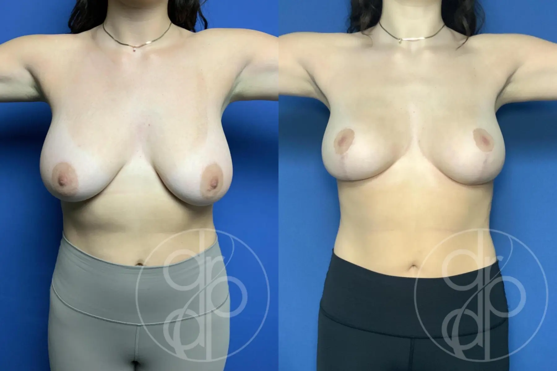 Breast Reduction: Patient 27 - Before and After 2