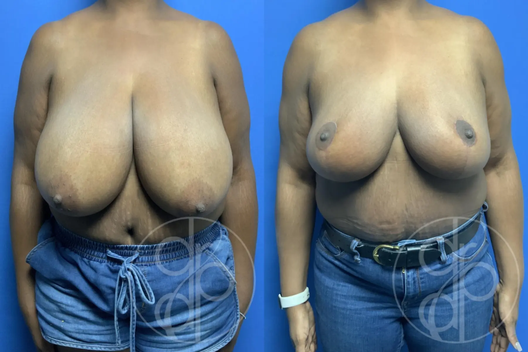 patient 11855 breast reduction before and after result - Before and After