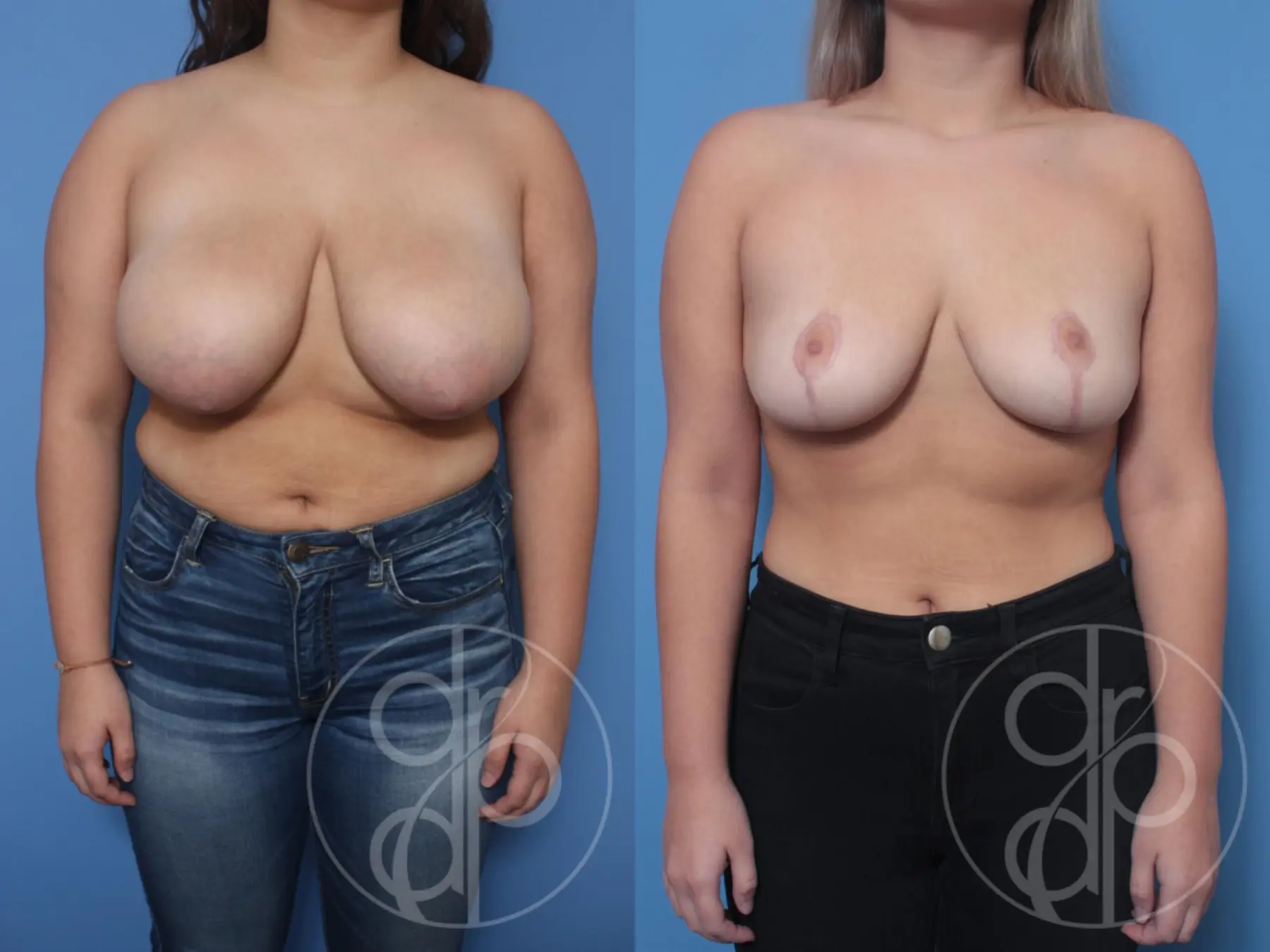 patient 10582 breast reduction before and after result - Before and After