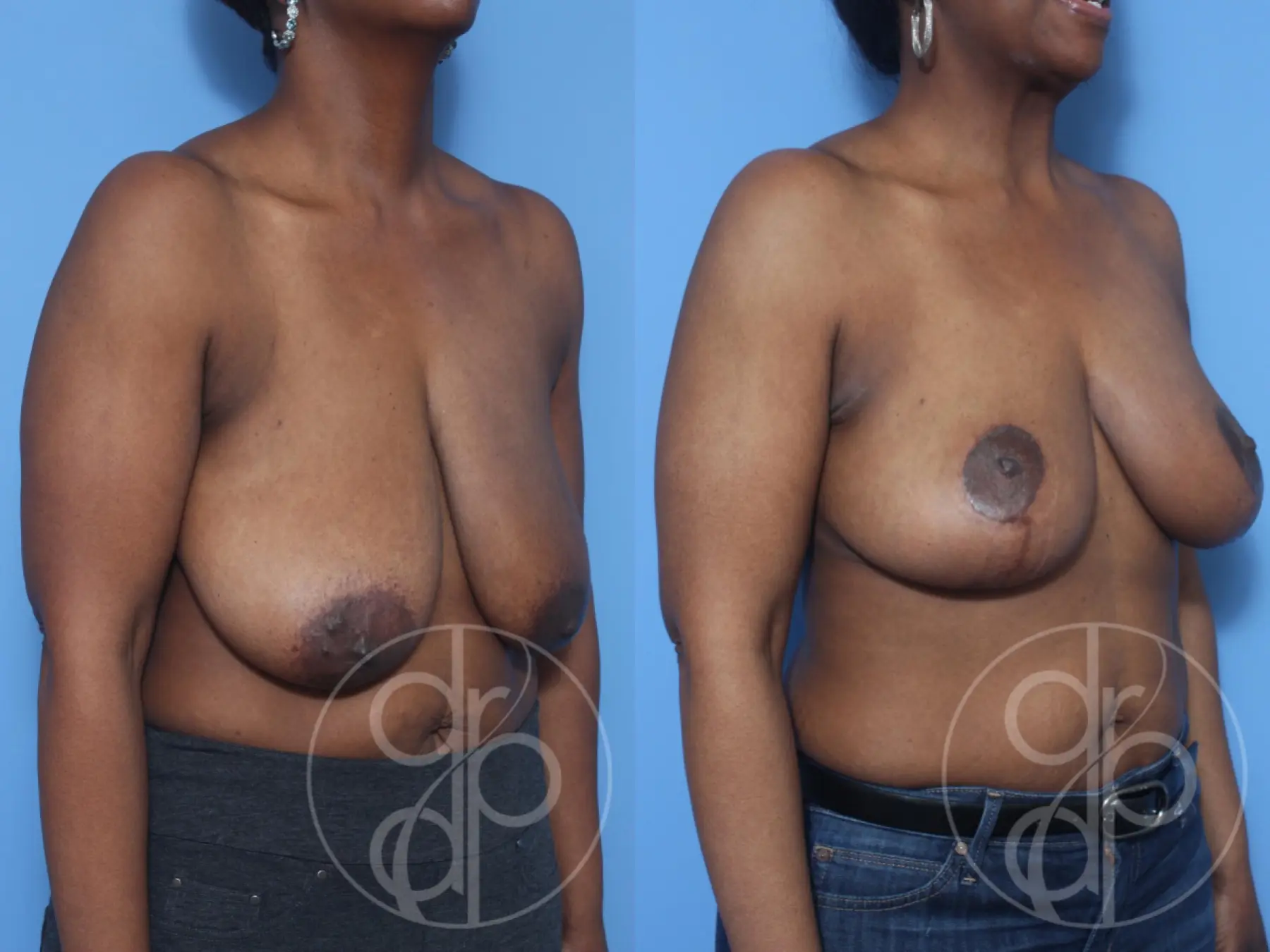 patient 13203 breast reduction before and after result - Before and After 2