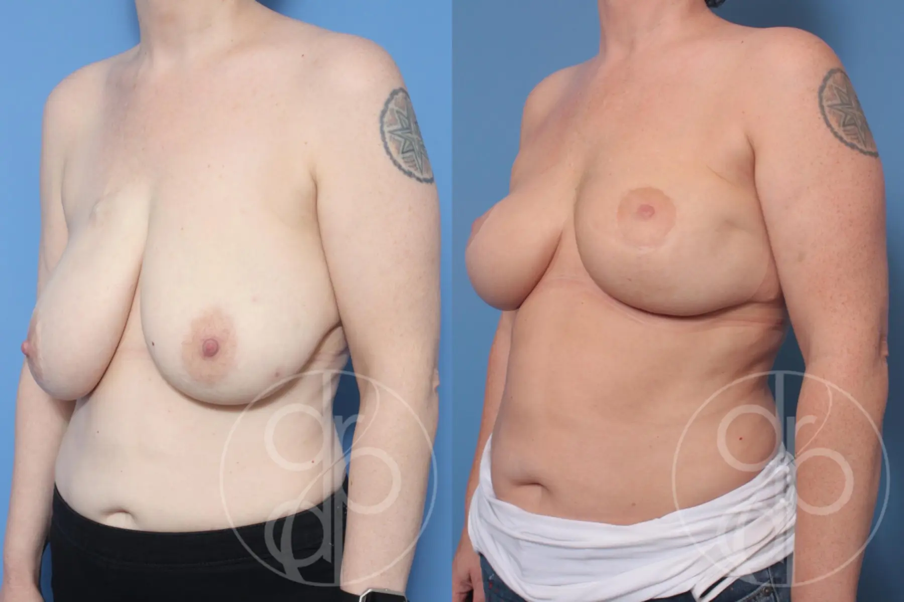 patient 10592 breast reduction before and after result - Before and After 2