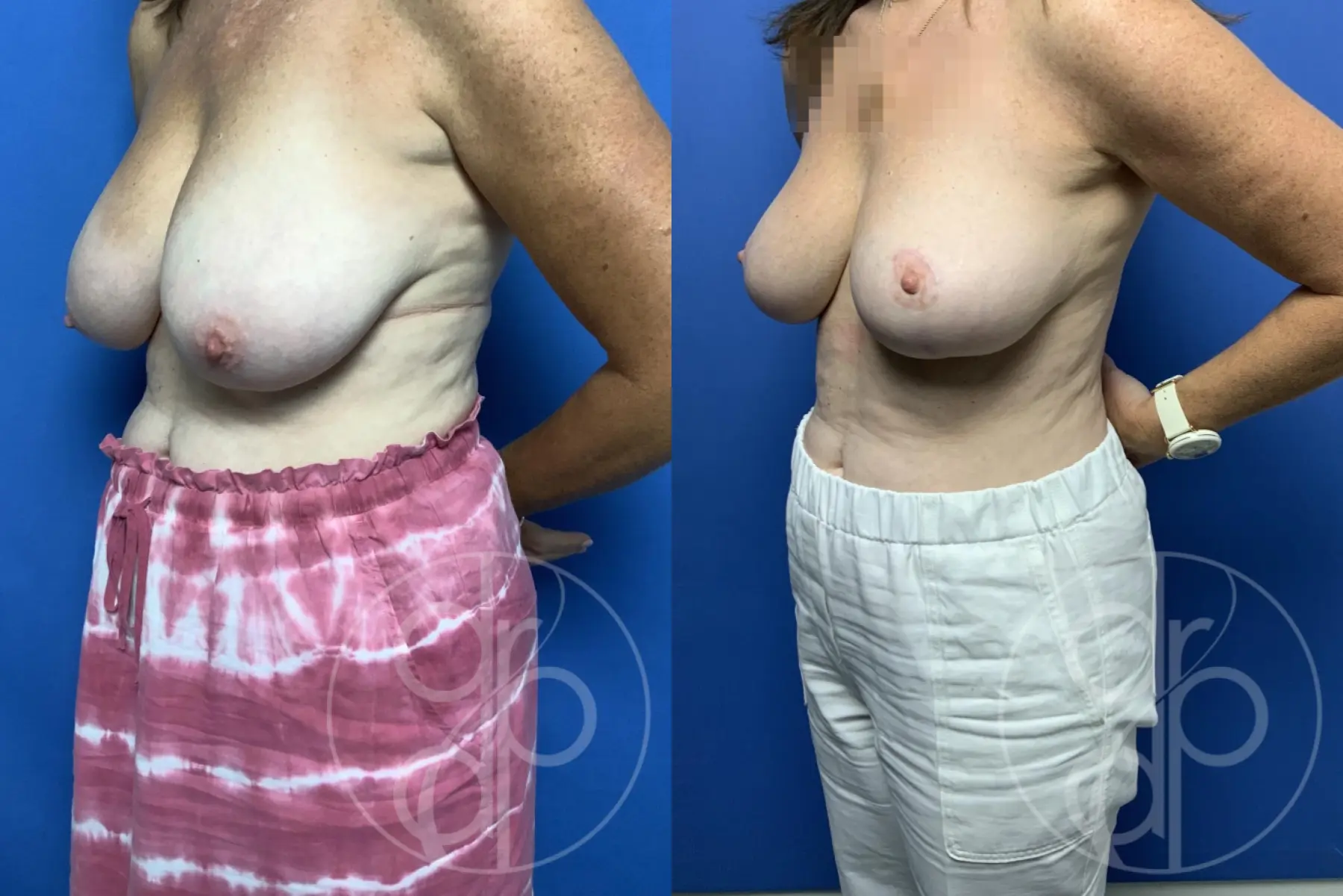 patient 10134 breast reduction before and after result - Before and After 3