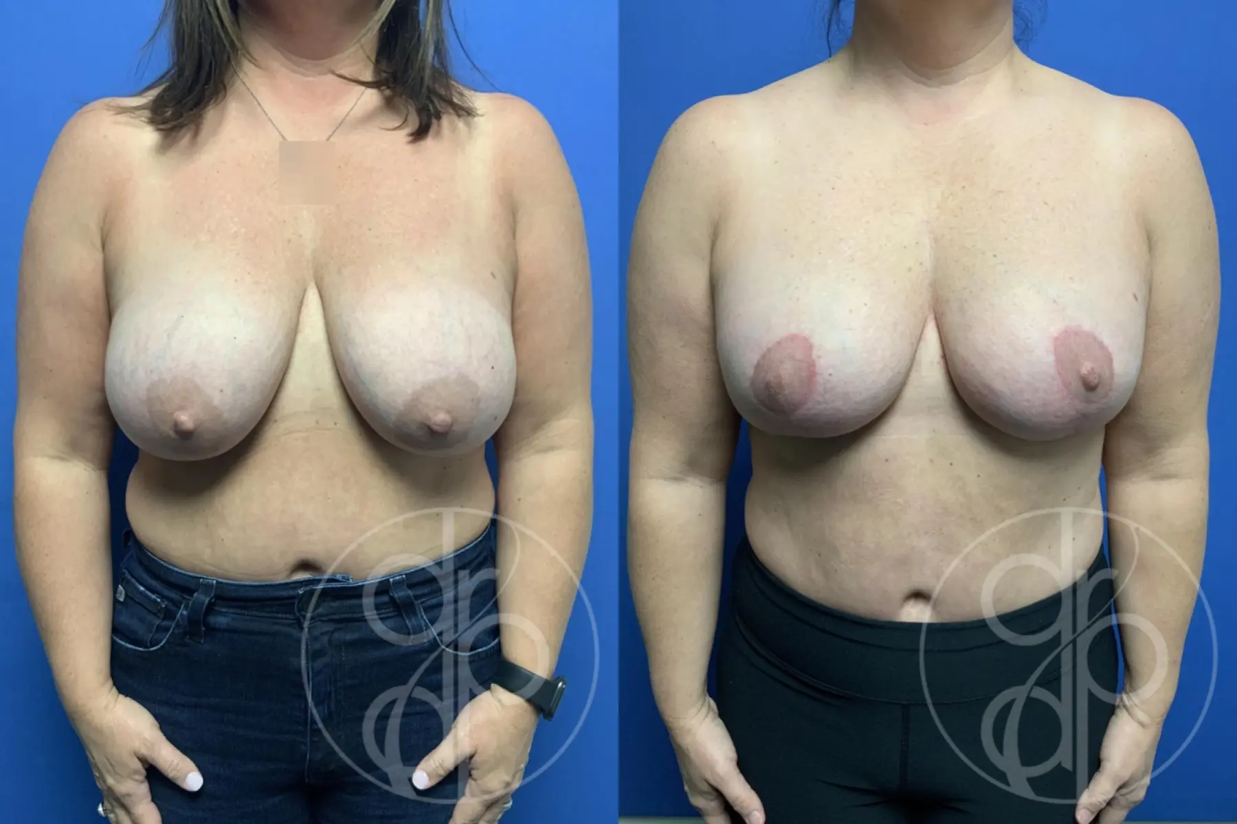 patient 13866 breast reduction before and after result - Before and After