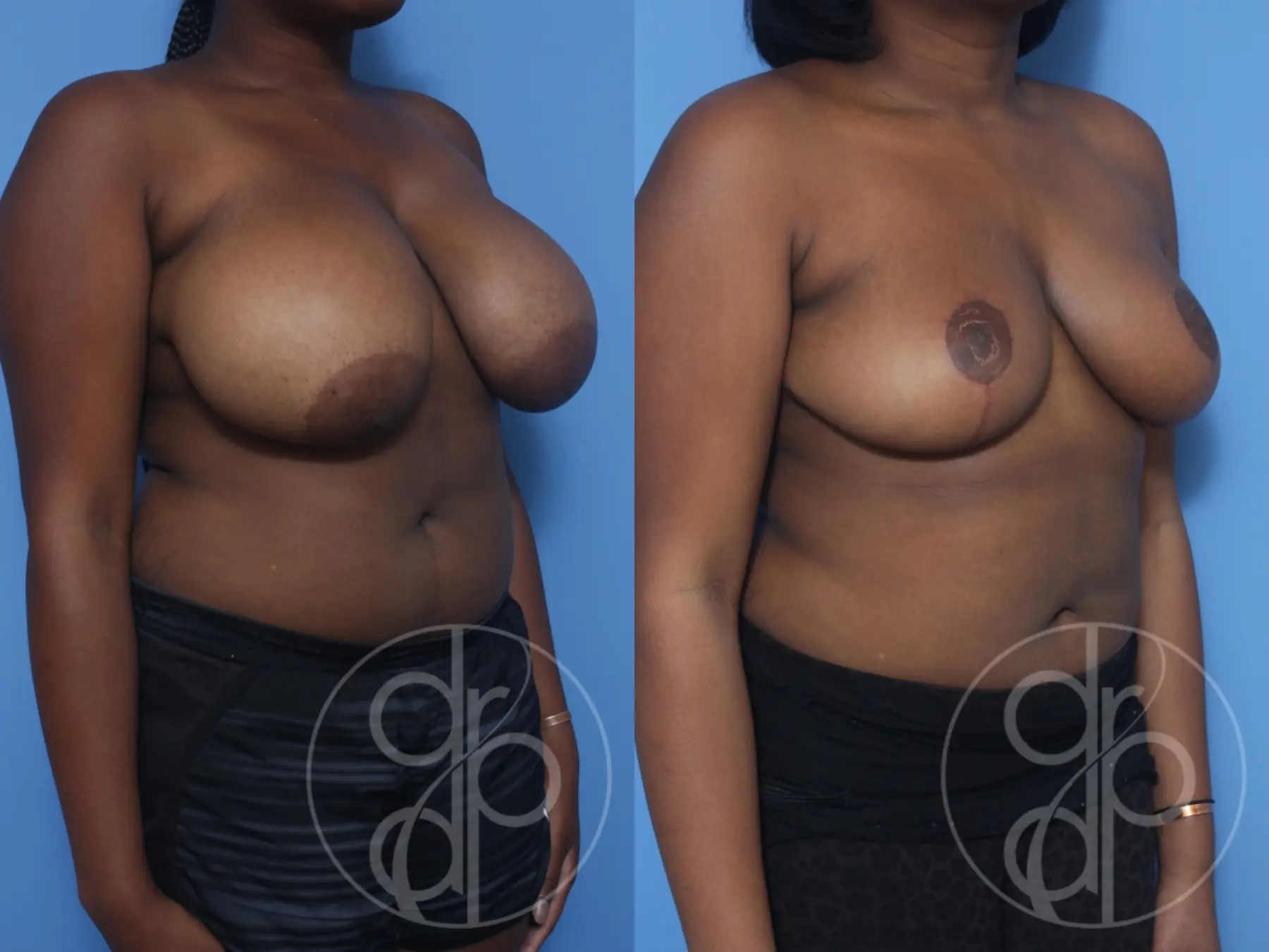 patient 13173 breast reduction before and after result - Before and After 3
