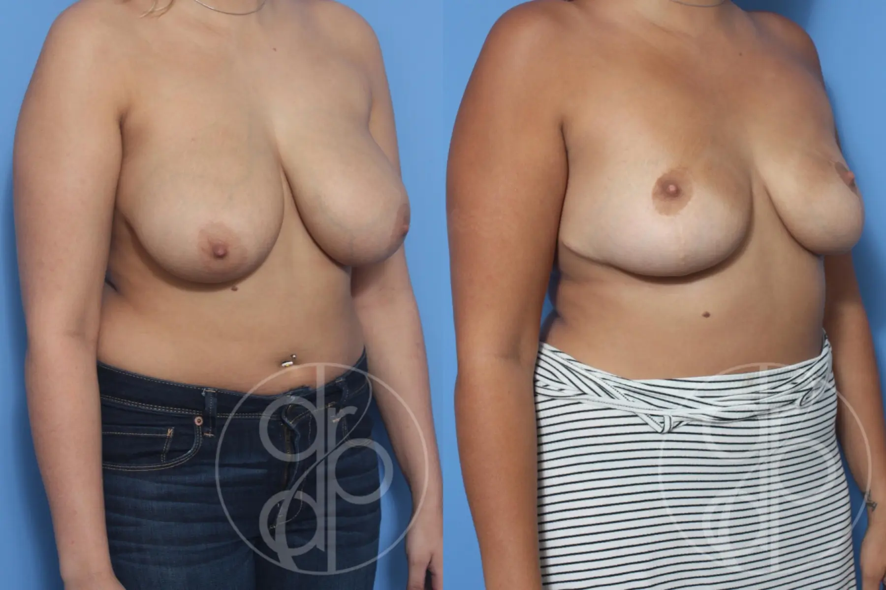 patient 13143 breast reduction before and after result - Before and After 2