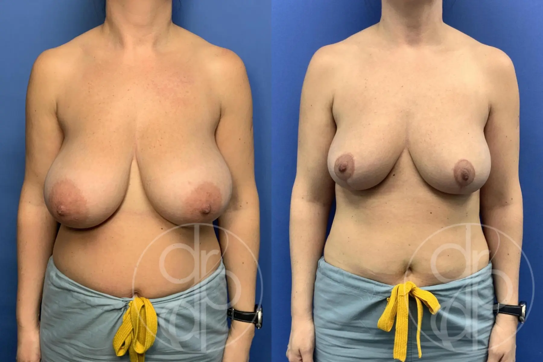 Patient 14506 Breast Reduction procedure before and after result - Before and After