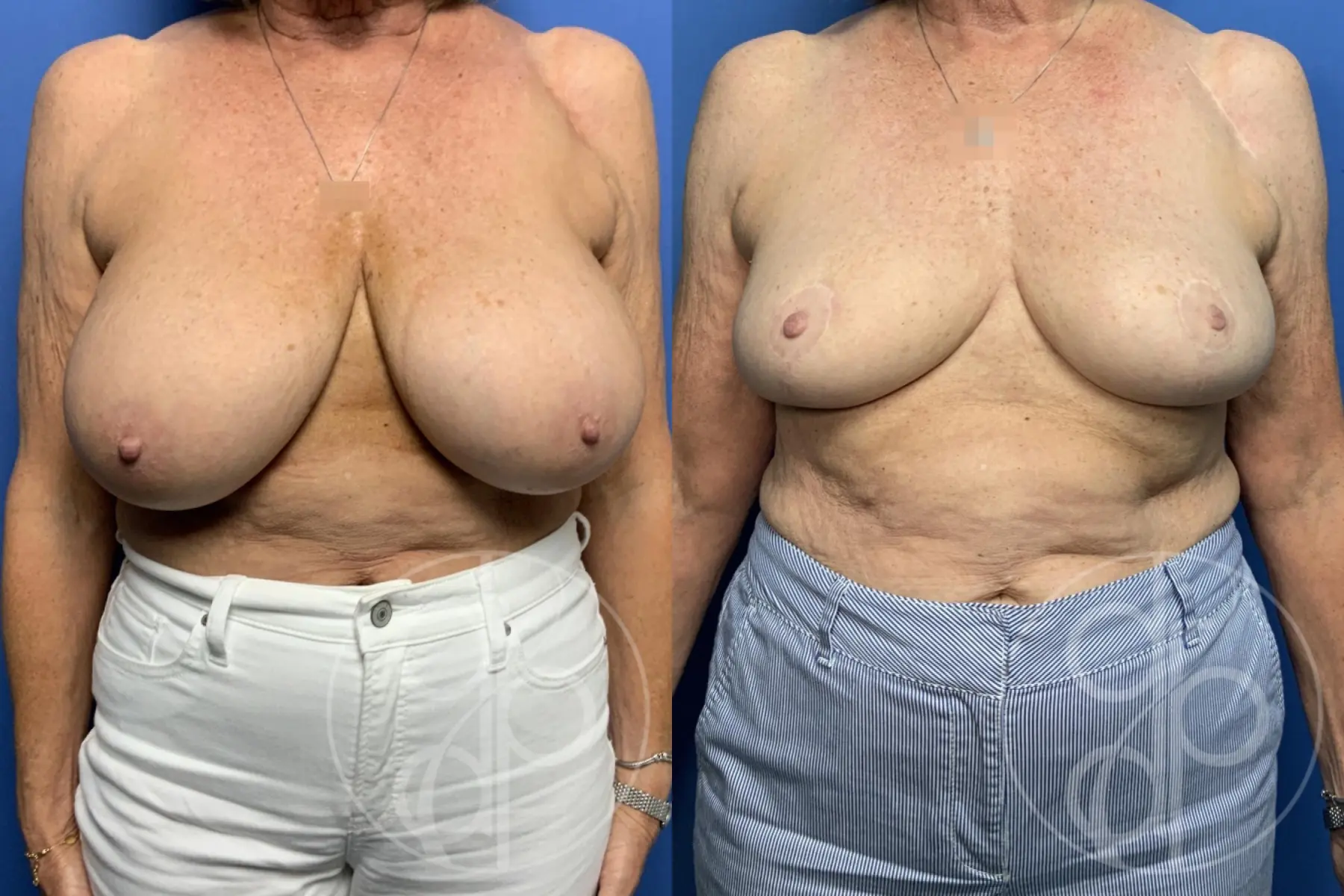 patient 13401 breast reduction before and after result - Before and After