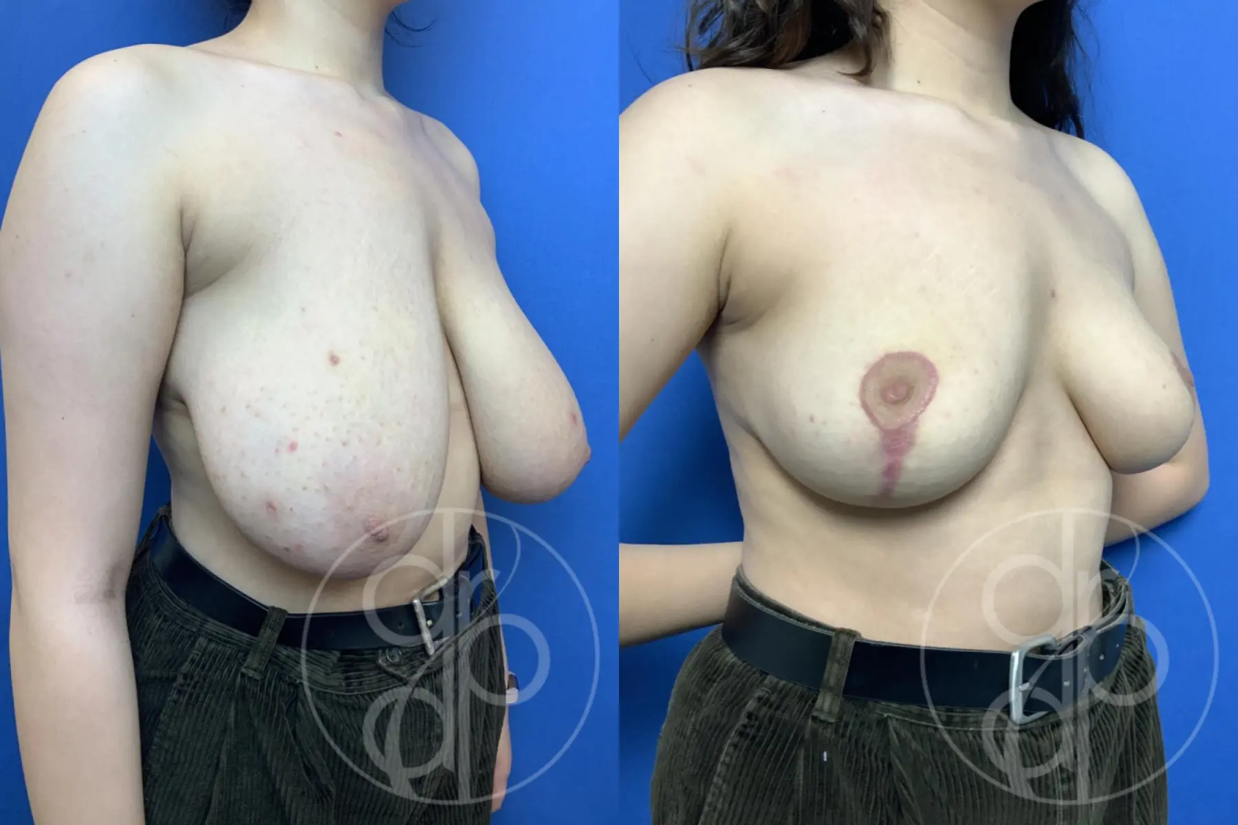 patient 11849 breast reduction before and after result - Before and After 3