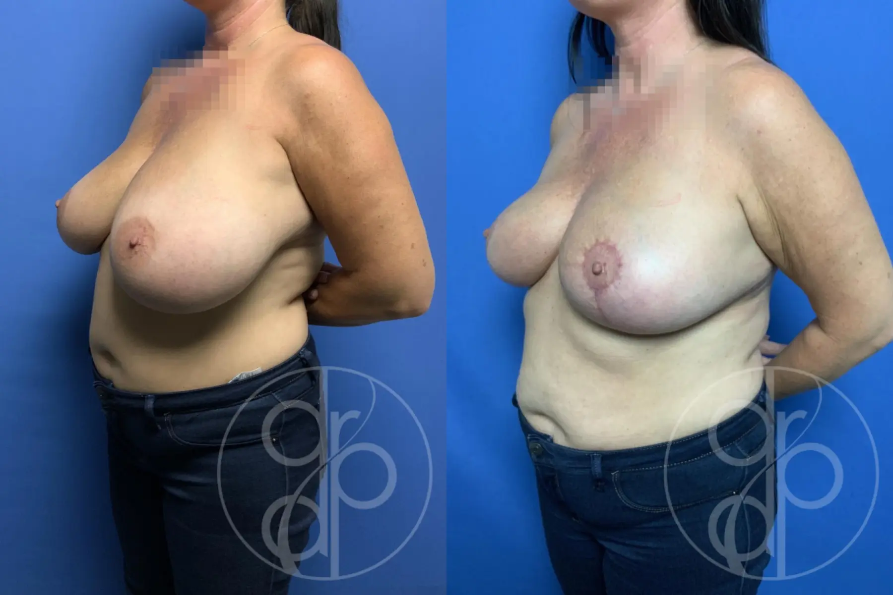 patient 13362 breast reduction before and after result - Before and After 2