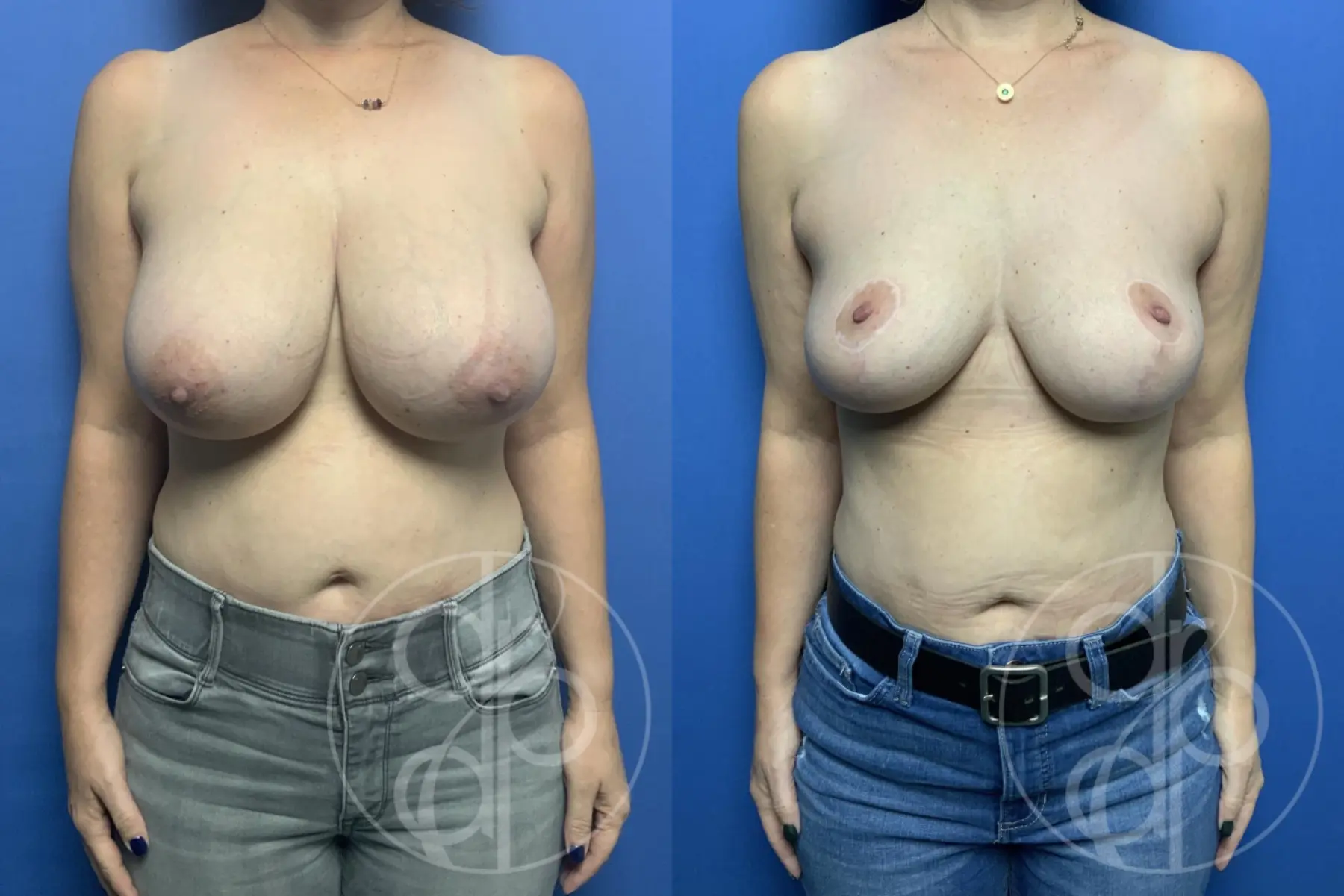 patient 12669 breast reduction before and after result - Before and After 1