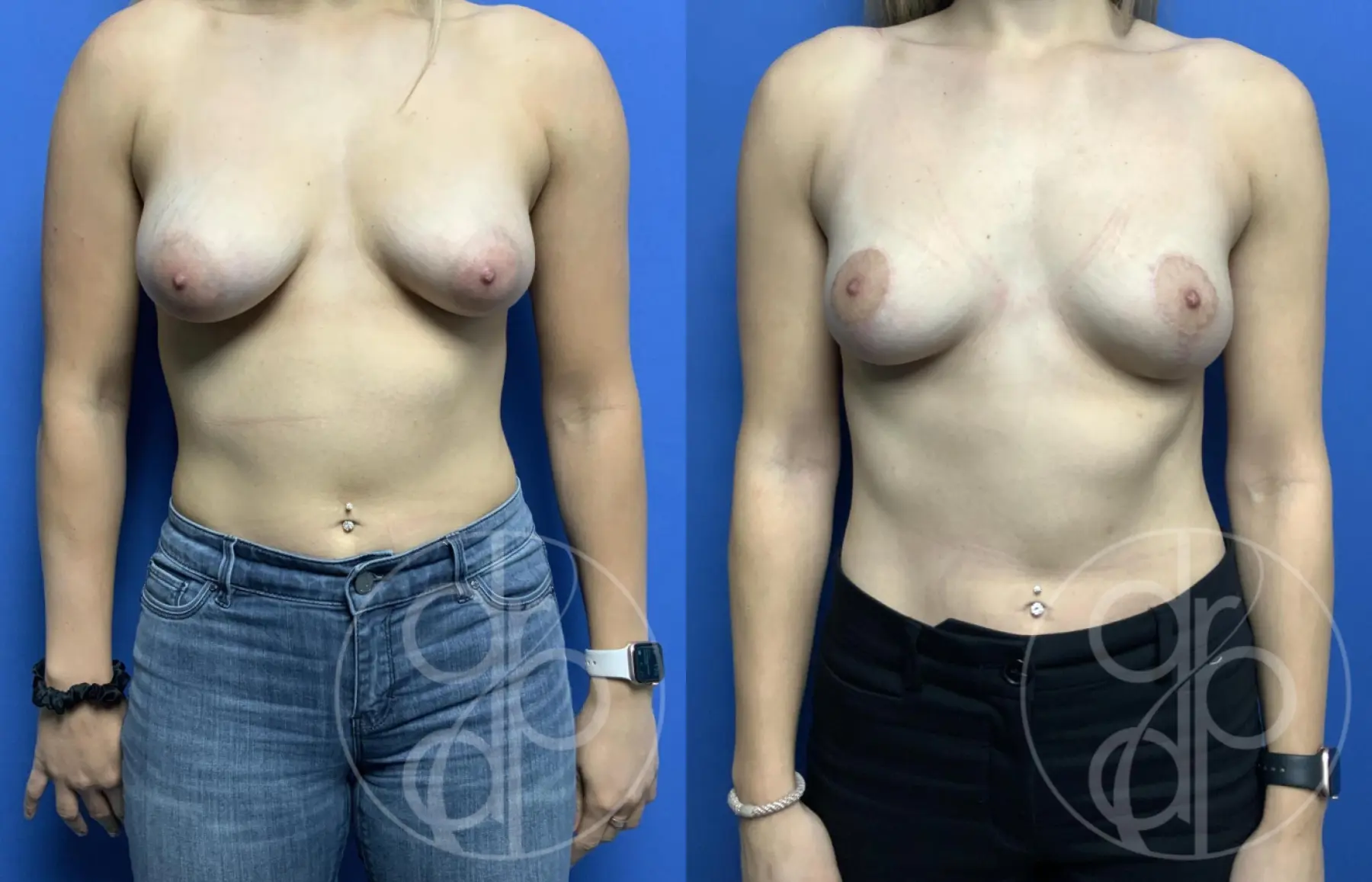 patient 11935 breast reduction before and after result - Before and After