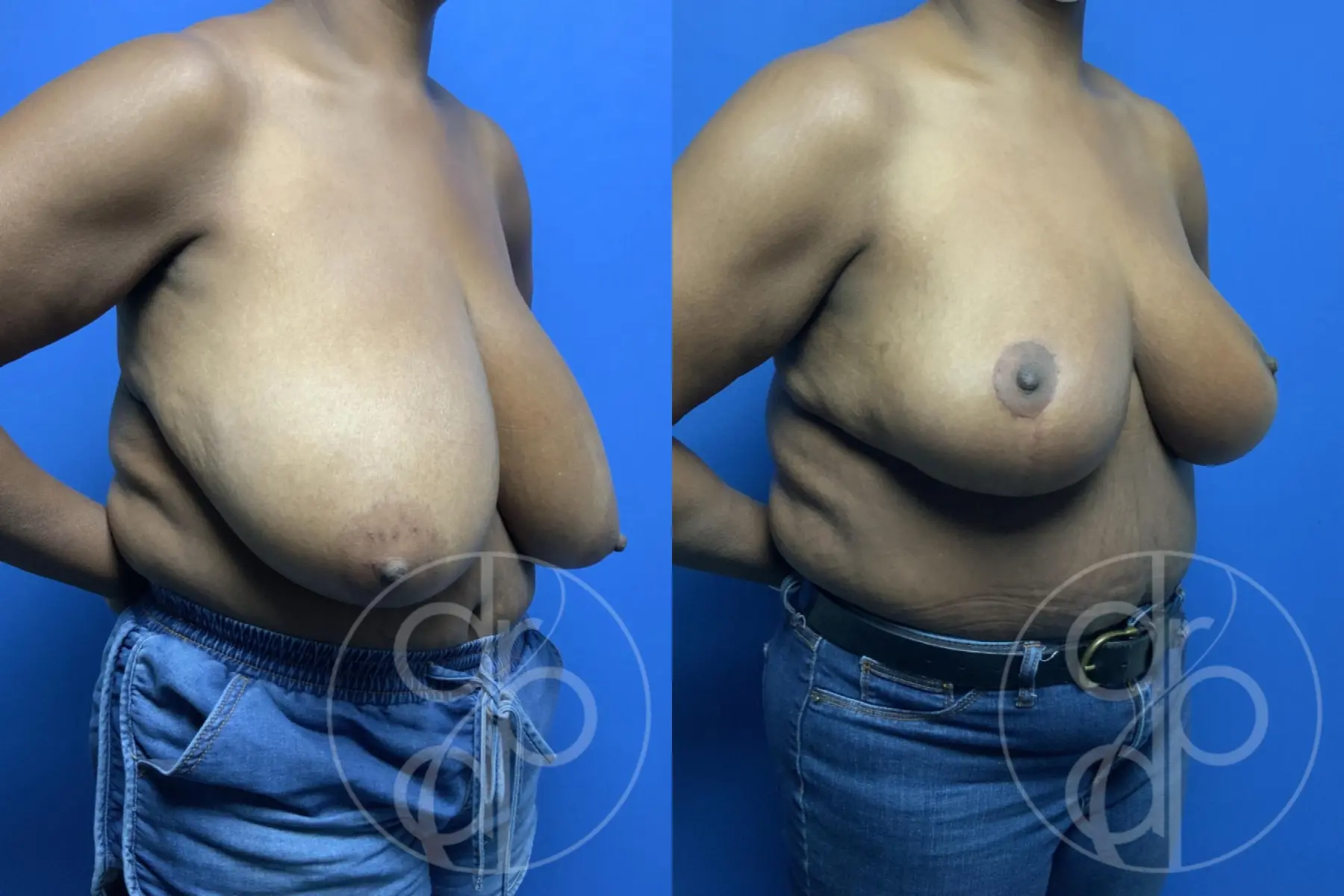 patient 11855 breast reduction before and after result - Before and After 2