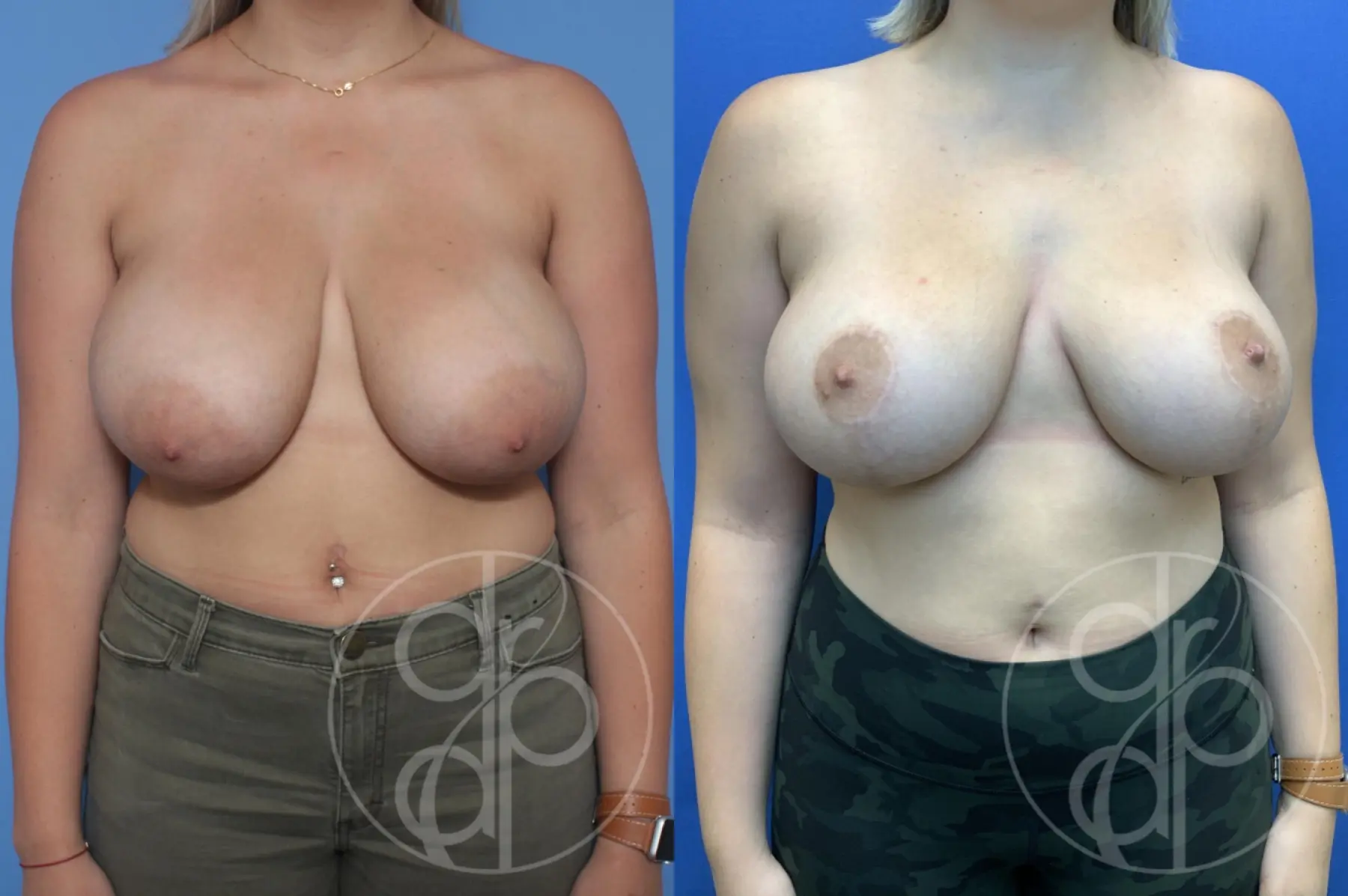 patient 11936 breast reduction before and after result - Before and After