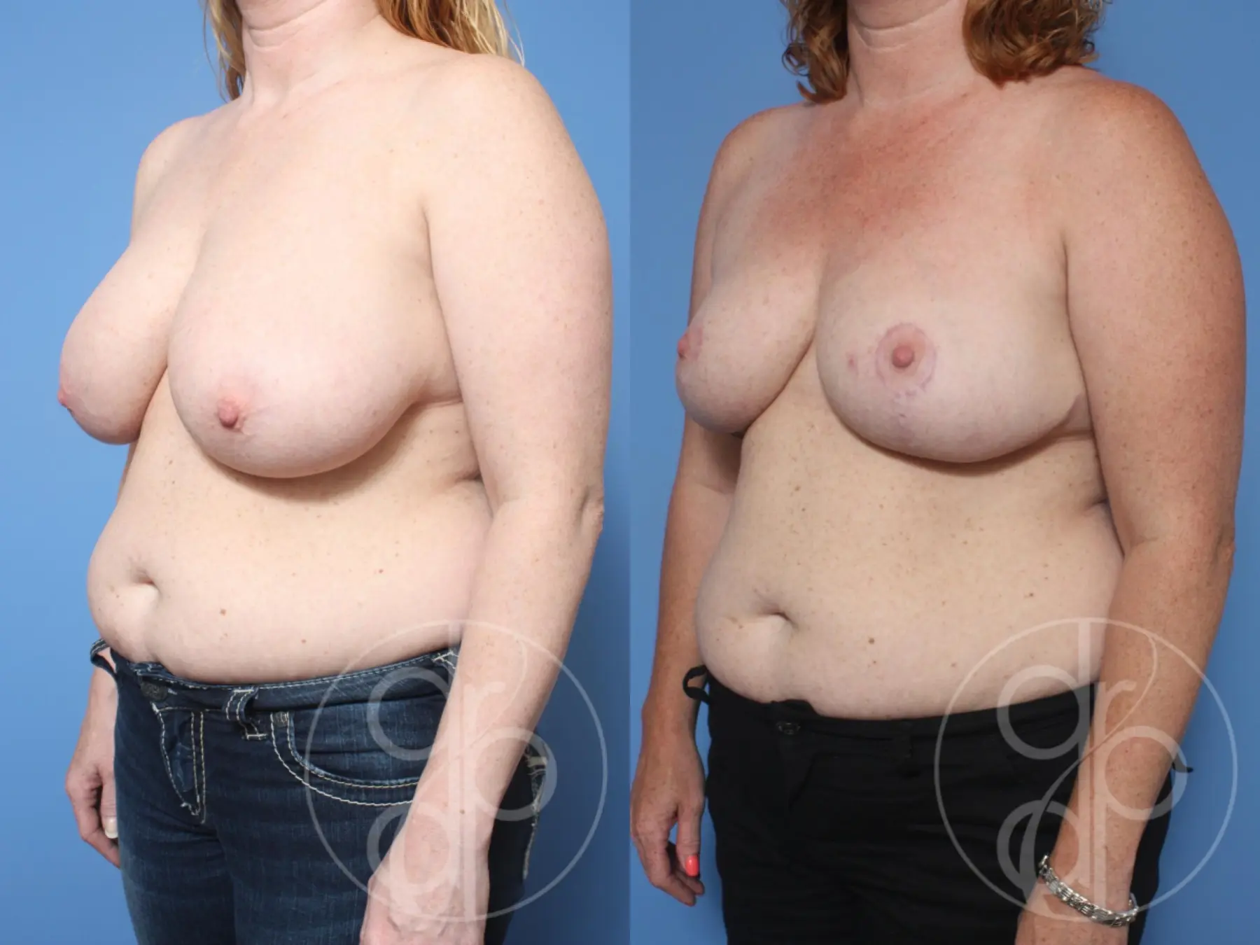 Breast Reduction: Patient 7 - Before and After 2