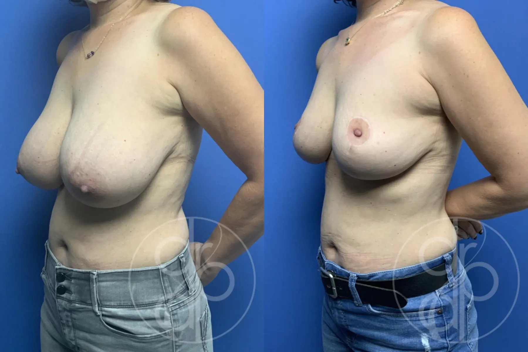 Breast Reduction: Patient 1 - Before and After 3