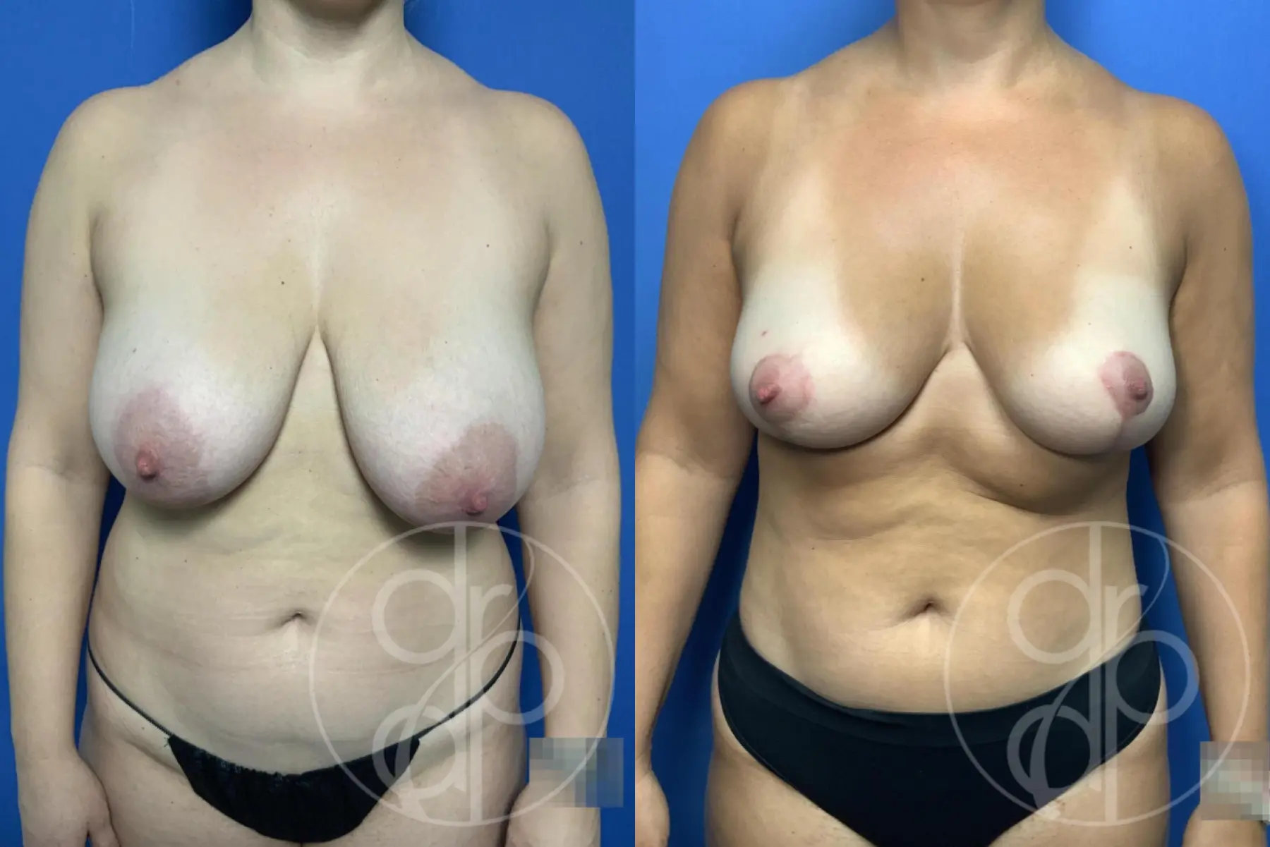 Breast Reduction: Patient 28 - Before and After 1