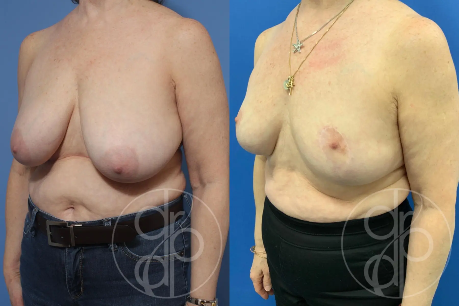 patient 10400 breast reduction before and after result - Before and After 3