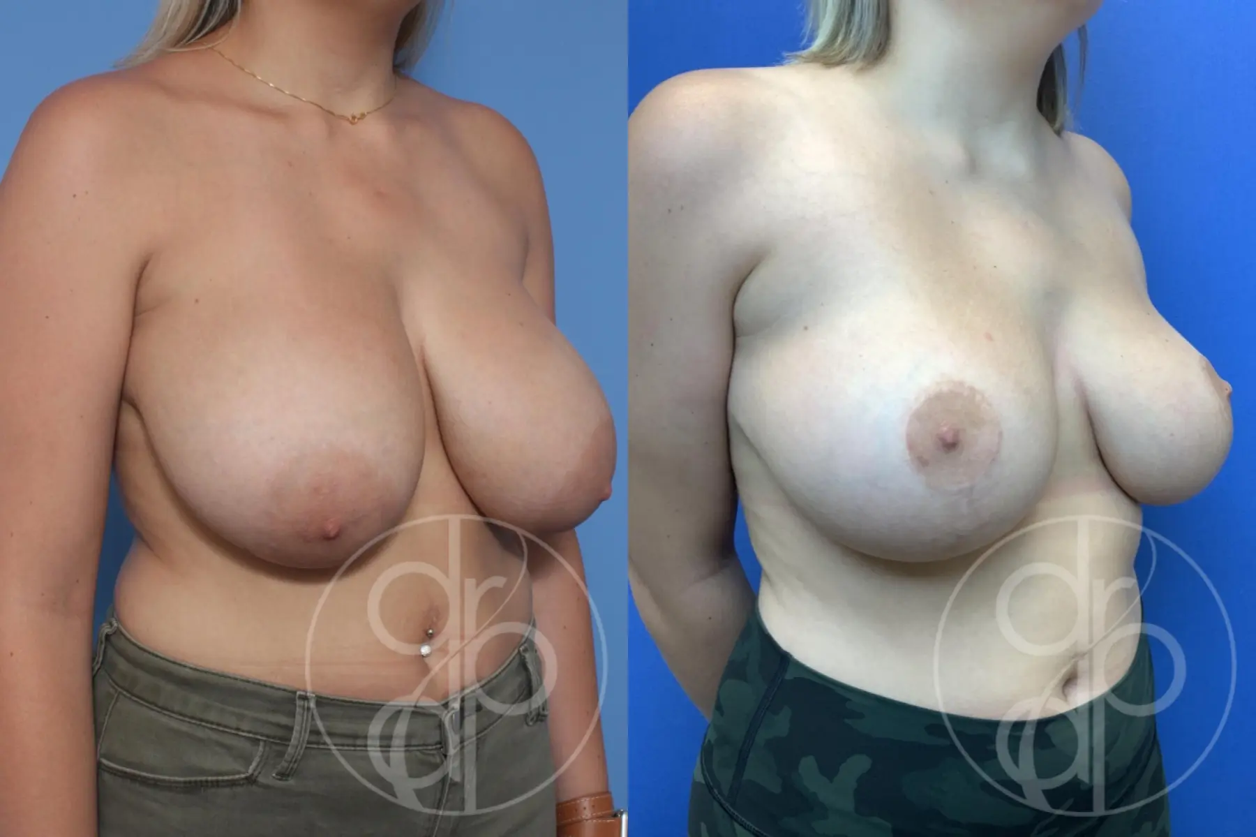 patient 11936 breast reduction before and after result - Before and After 2