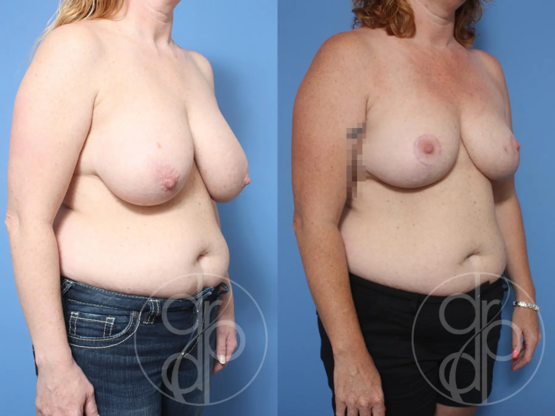 Breast Reduction: Patient 7 - Before and After 3