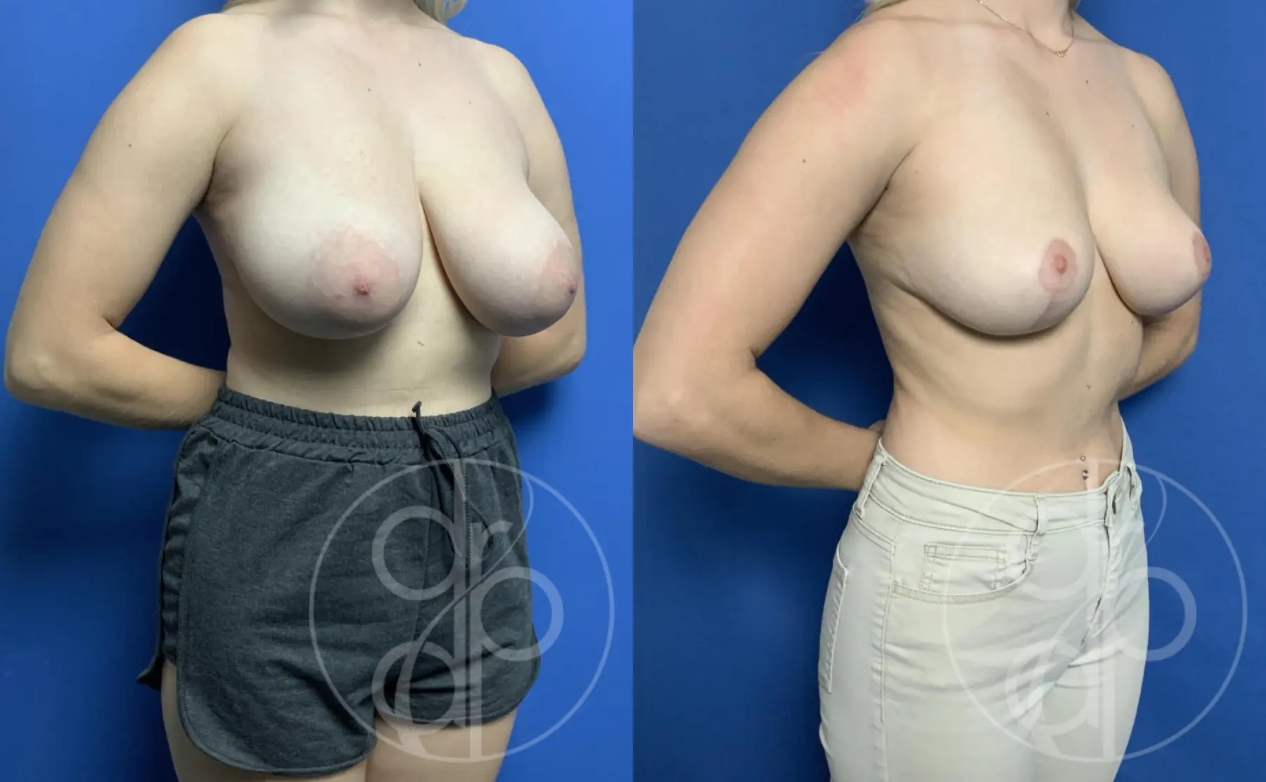 patient 12663 breast reduction before and after result - Before and After 3