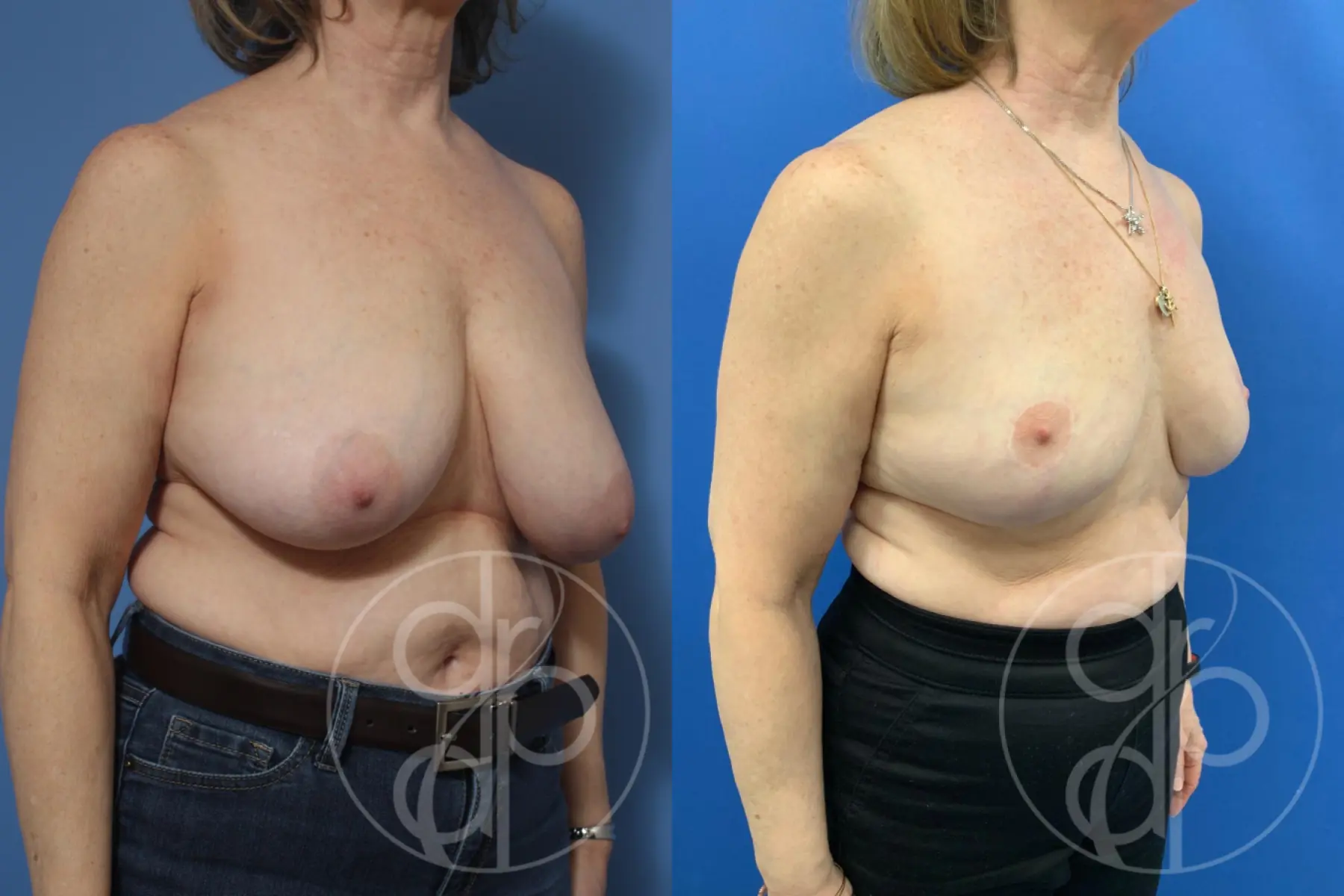 patient 10400 breast reduction before and after result - Before and After 2