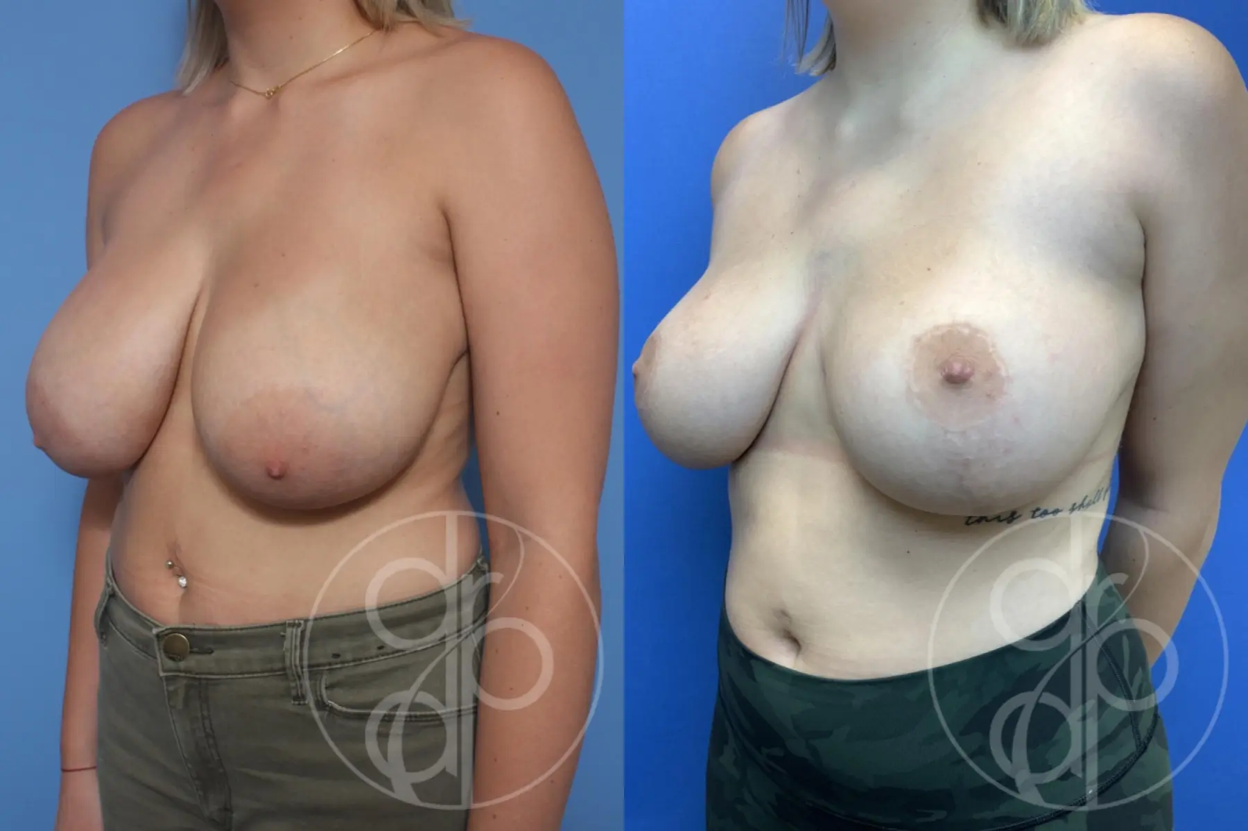 patient 11936 breast reduction before and after result - Before and After 3