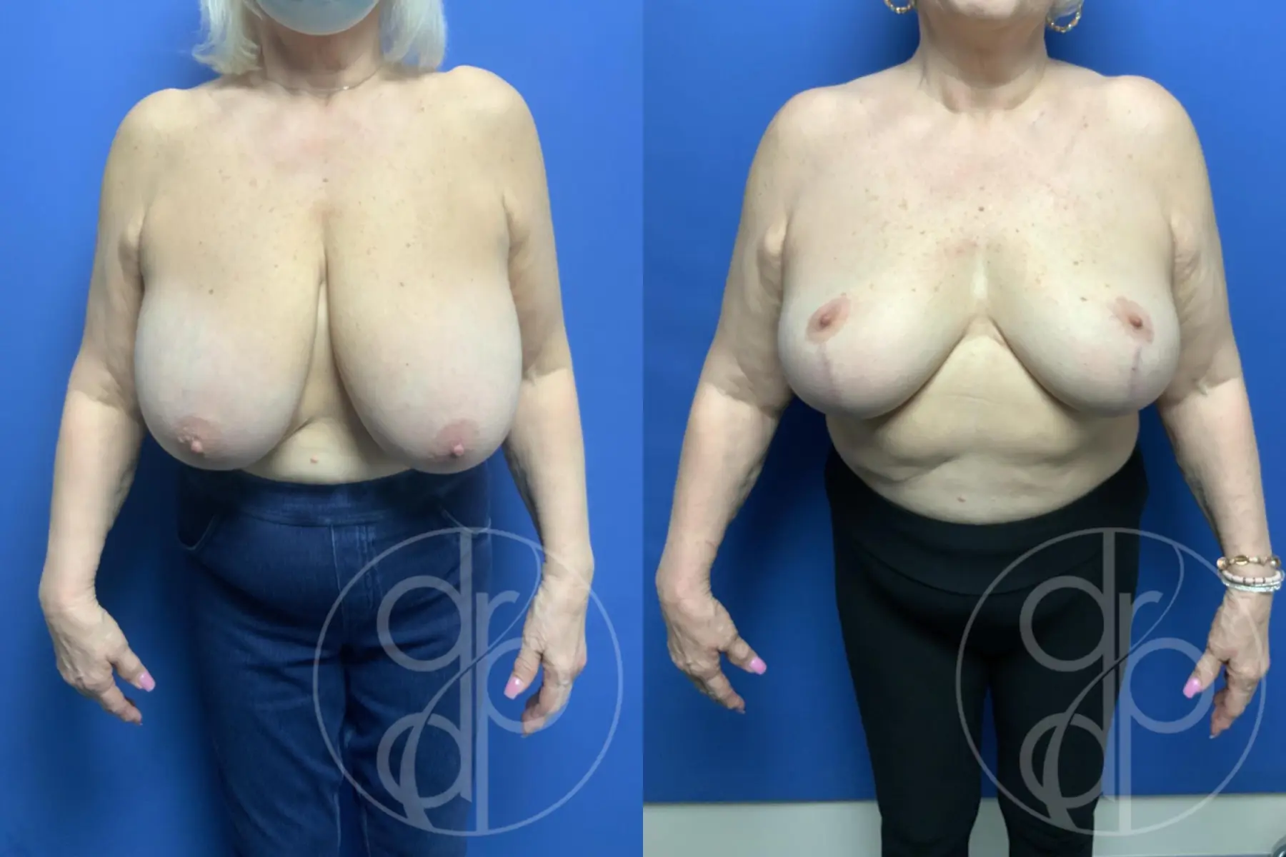 patient 12398 breast reduction before and after result - Before and After 1