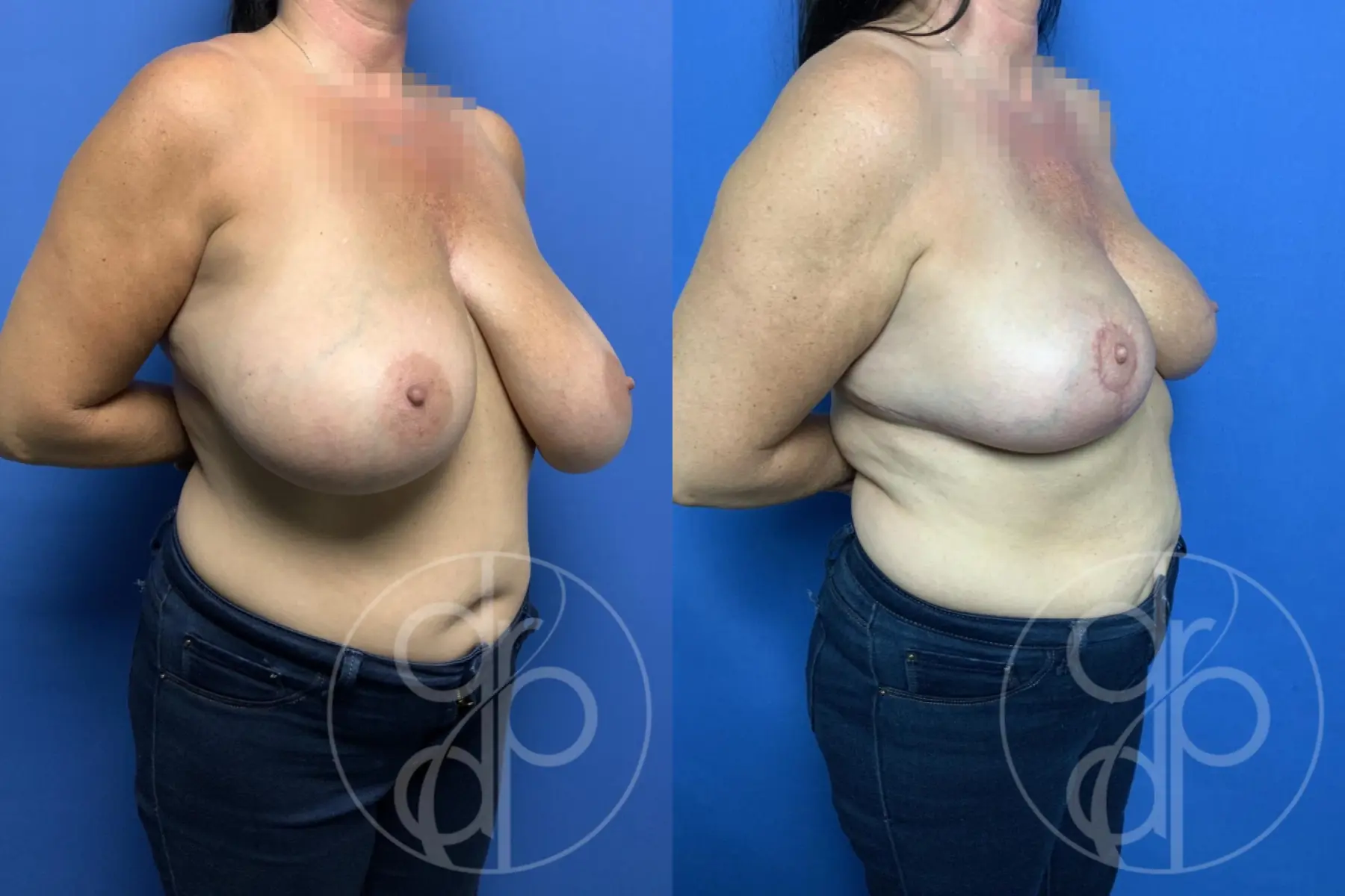 patient 13362 breast reduction before and after result - Before and After 3