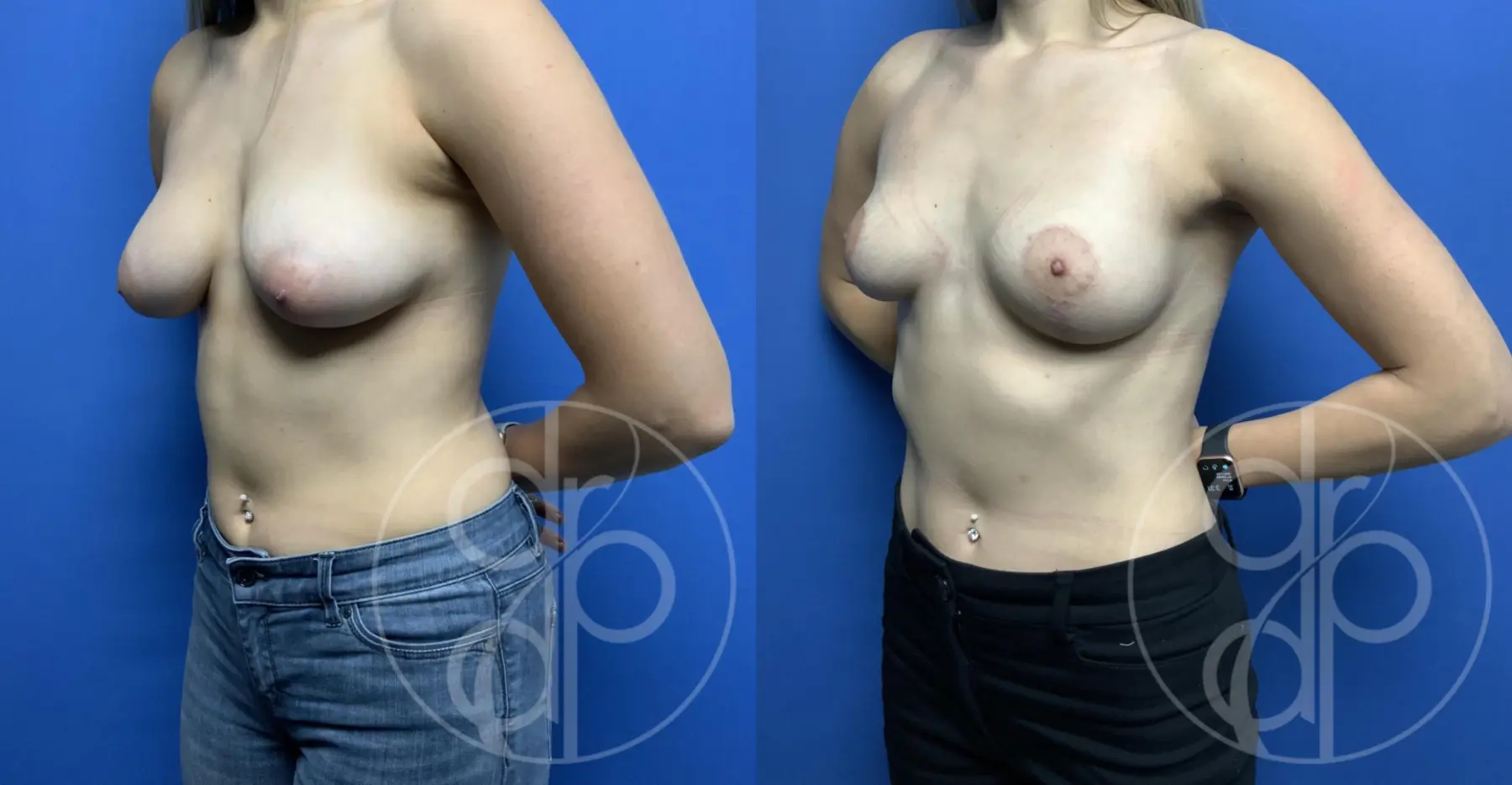 patient 11935 breast reduction before and after result - Before and After 3
