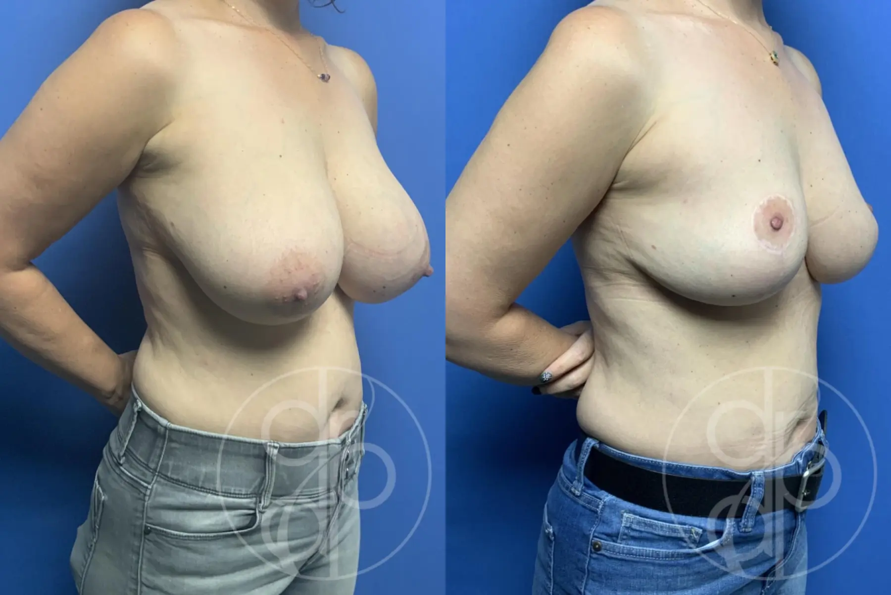 patient 12669 breast reduction before and after result - Before and After 2
