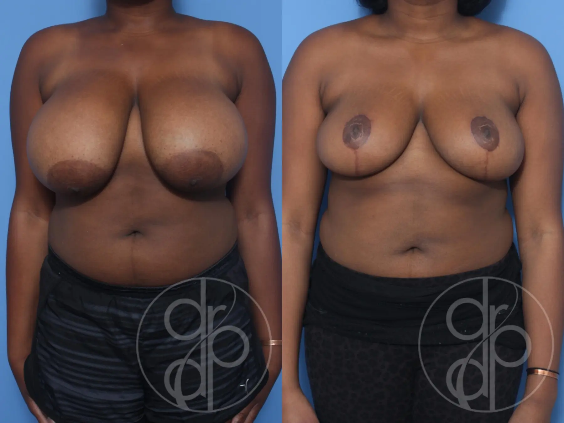 patient 13173 breast reduction before and after result - Before and After 1