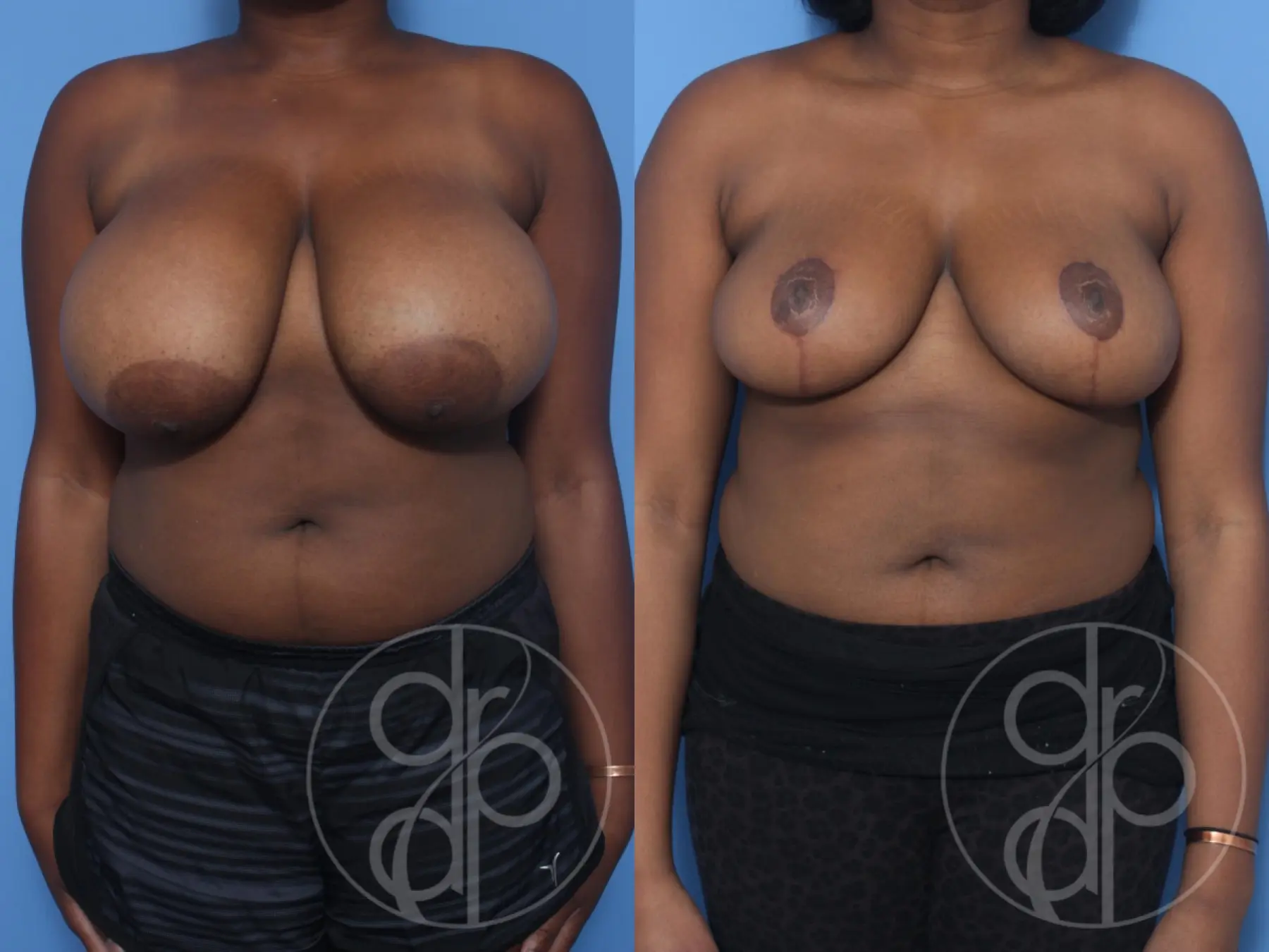 patient 13173 breast reduction before and after result - Before and After