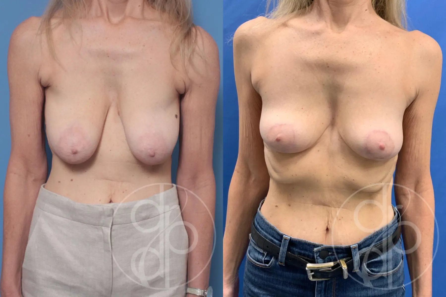 patient 10593 breast reduction before and after result - Before and After 1