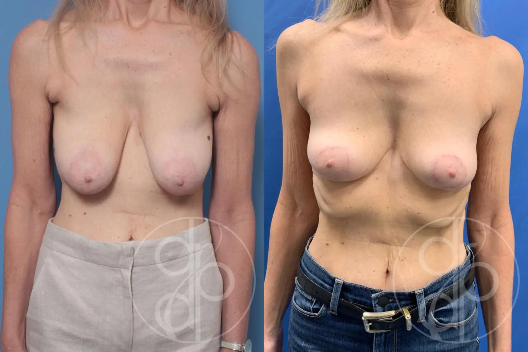 patient 10593 breast reduction before and after result - Before and After