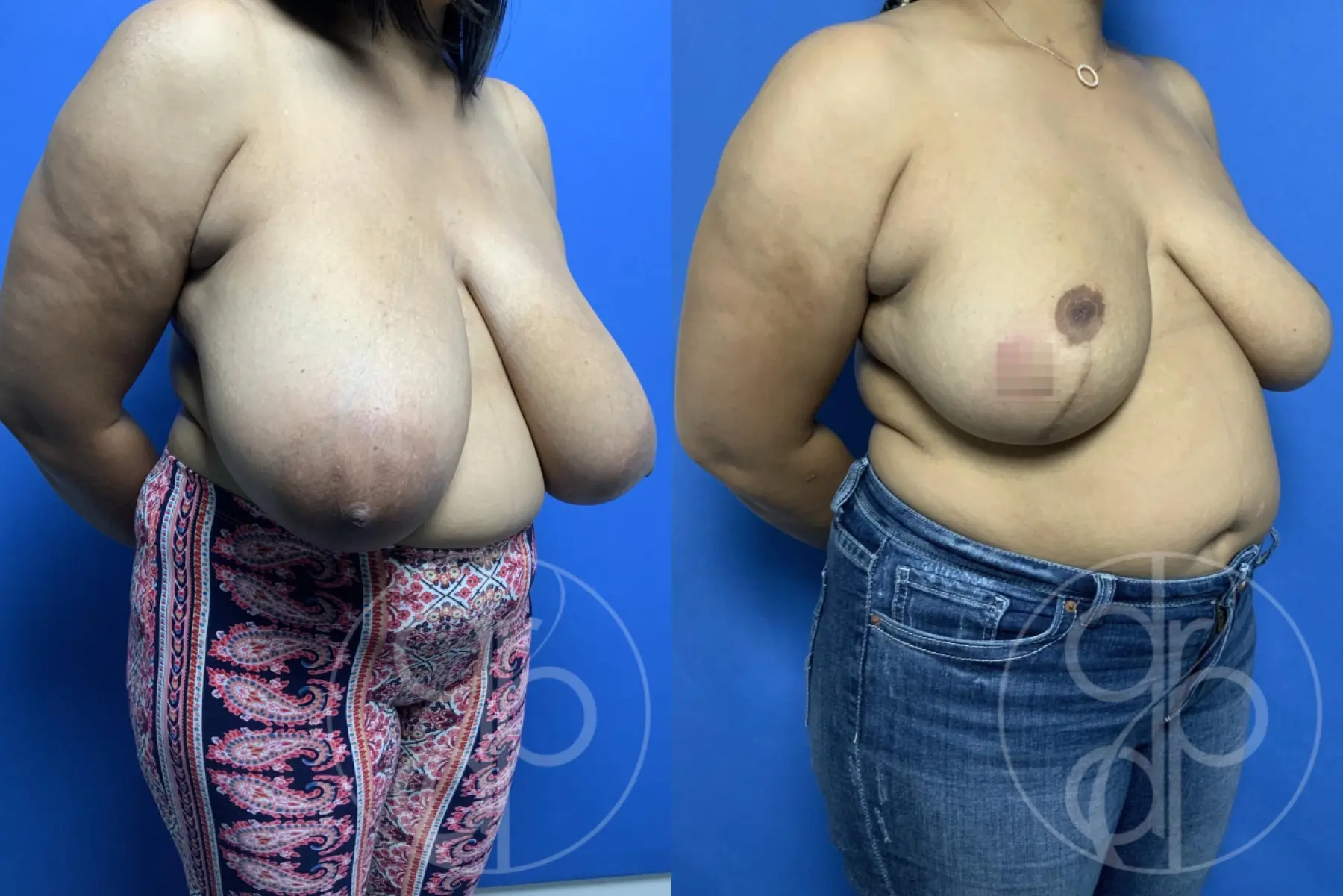 patient 12100 breast reduction before and after result - Before and After 3