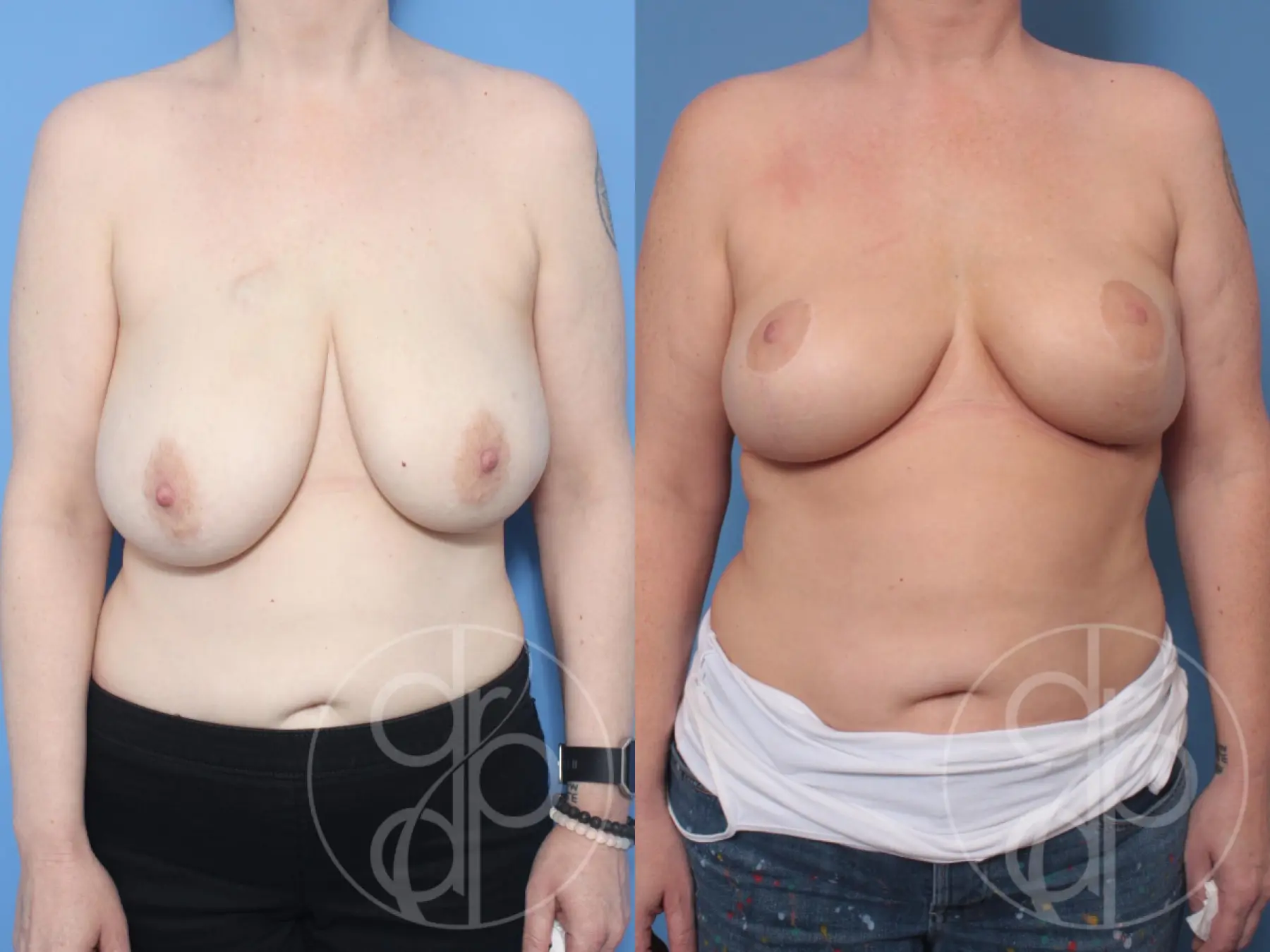 patient 10592 breast reduction before and after result - Before and After 1