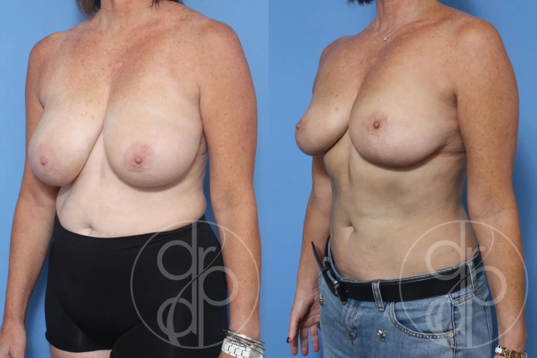 patient 13260 breast reduction before and after result - Before and After 2