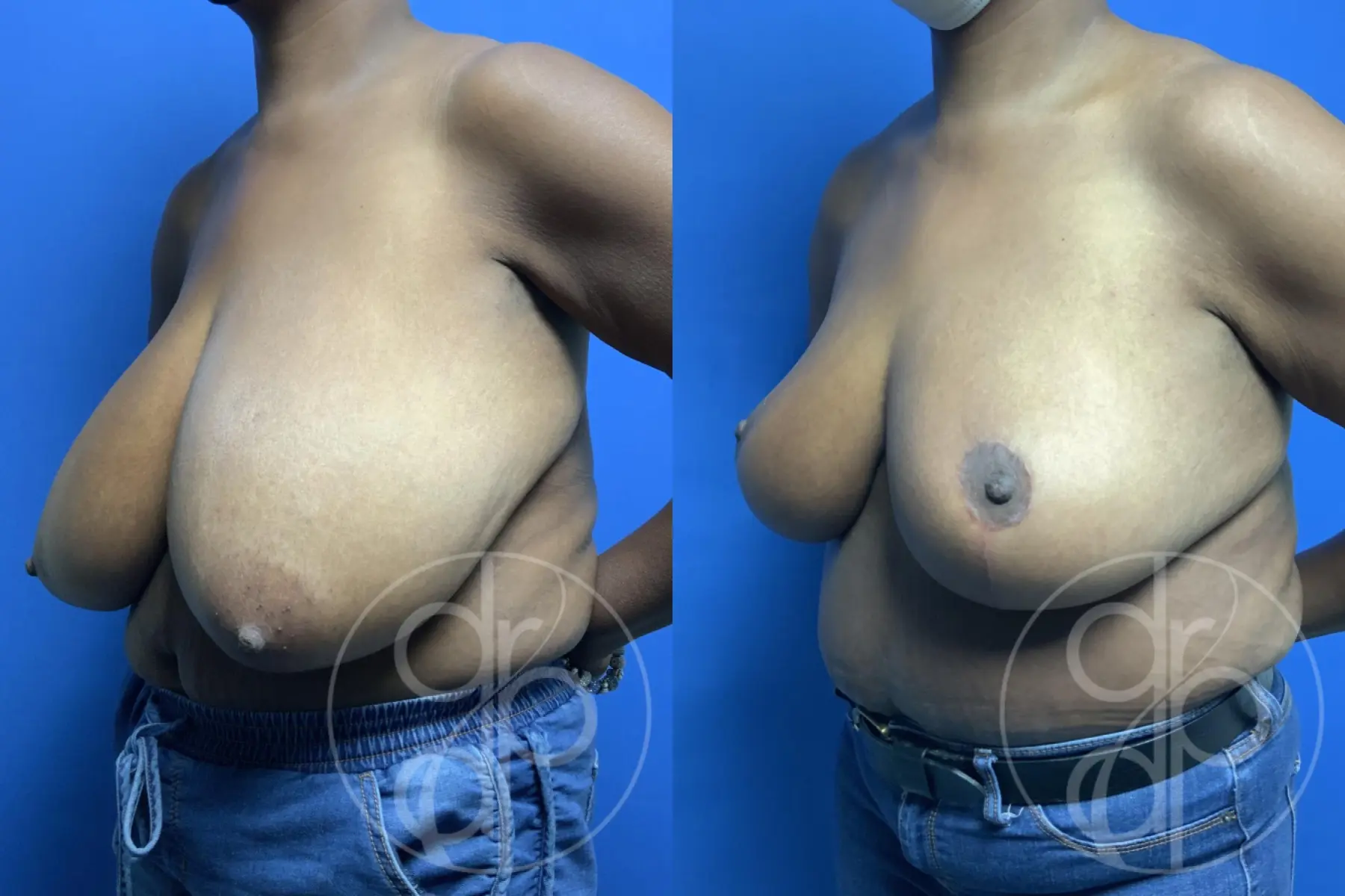 patient 11855 breast reduction before and after result - Before and After 3