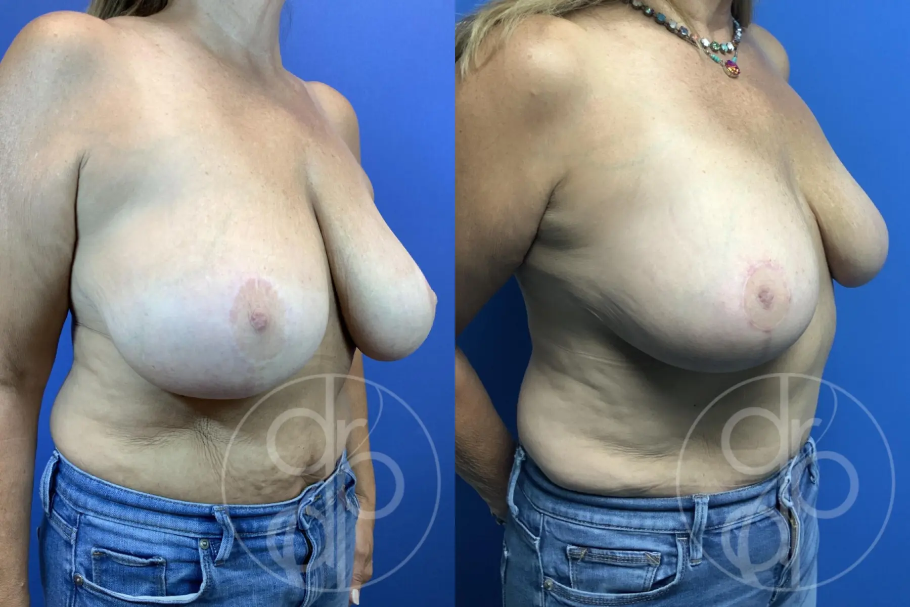 patient 11850 breast reduction before and after result - Before and After 3