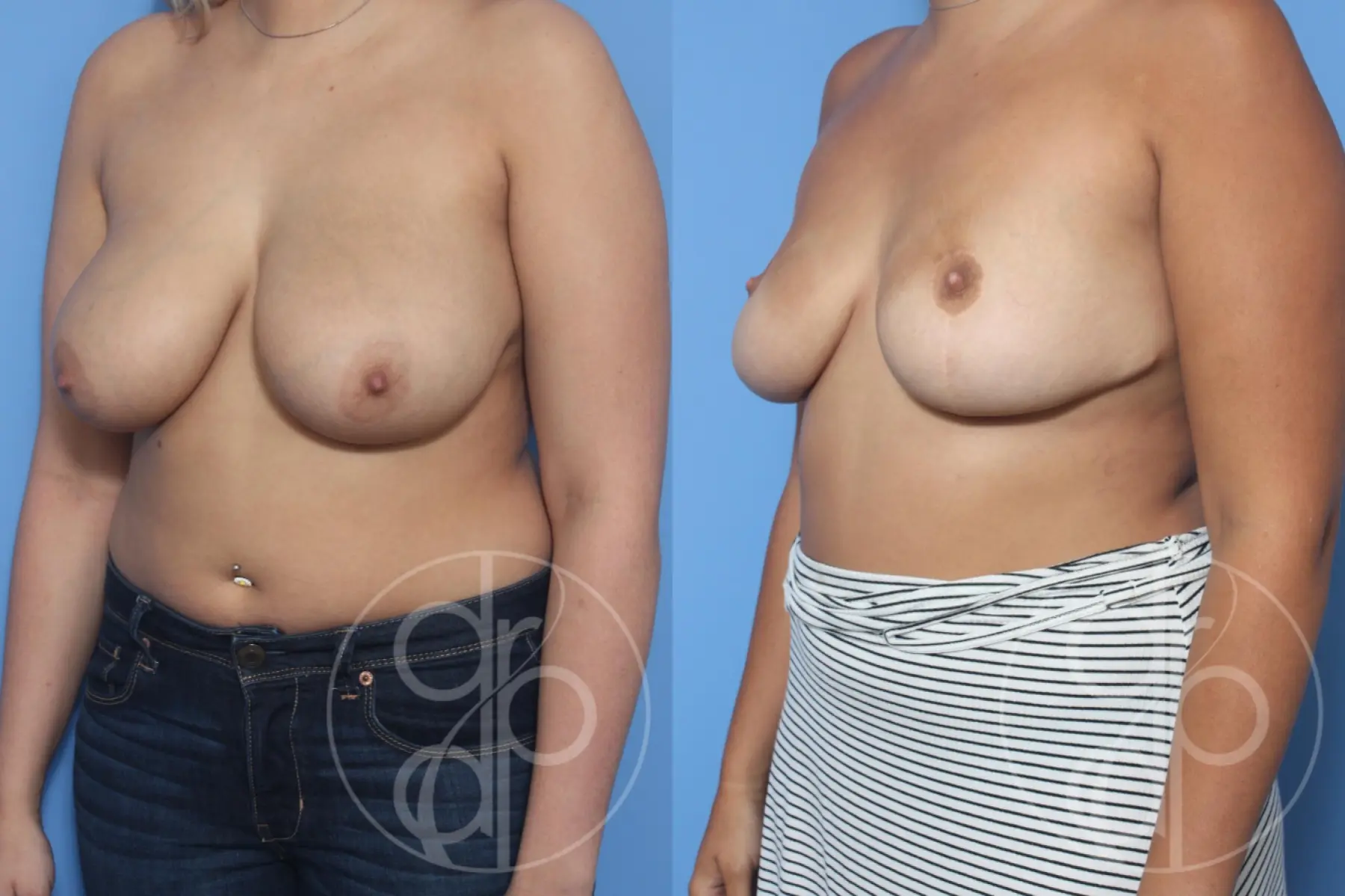 patient 13143 breast reduction before and after result - Before and After 3