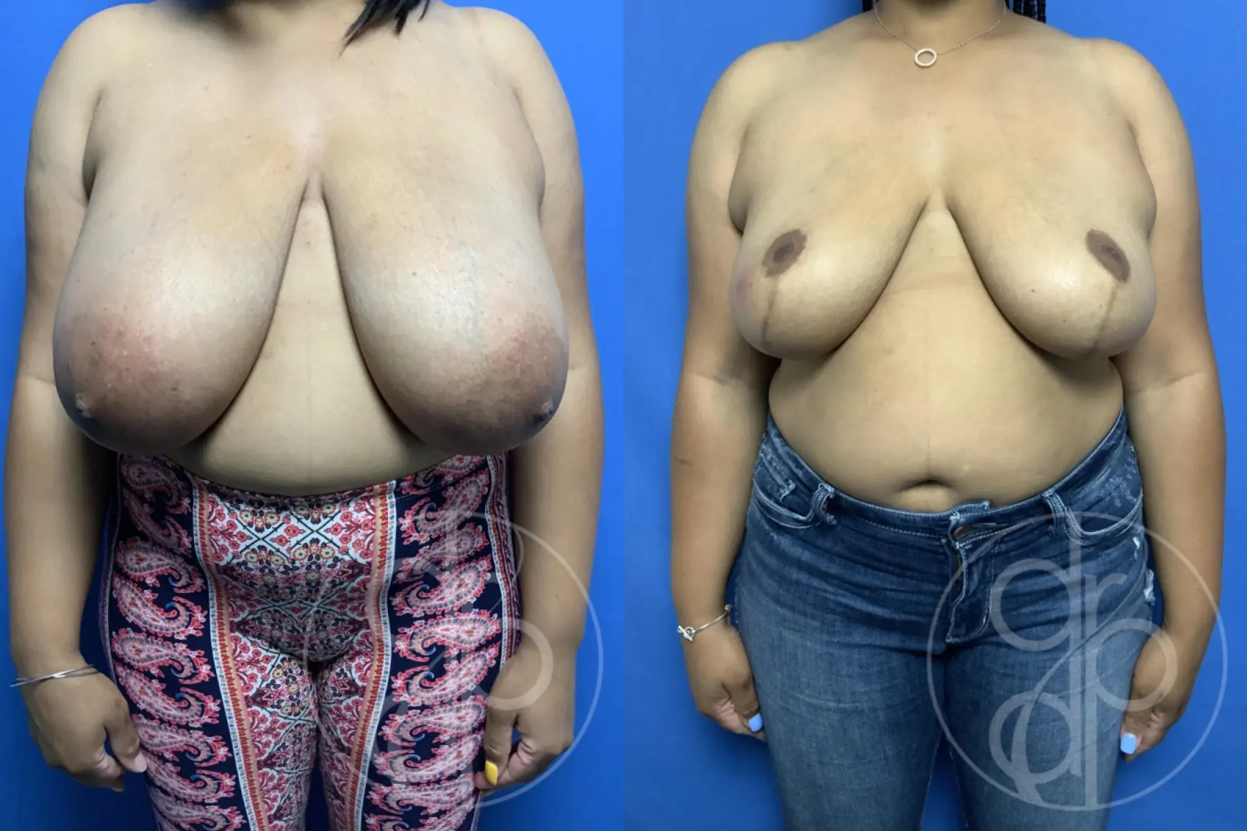 patient 12100 breast reduction before and after result - Before and After