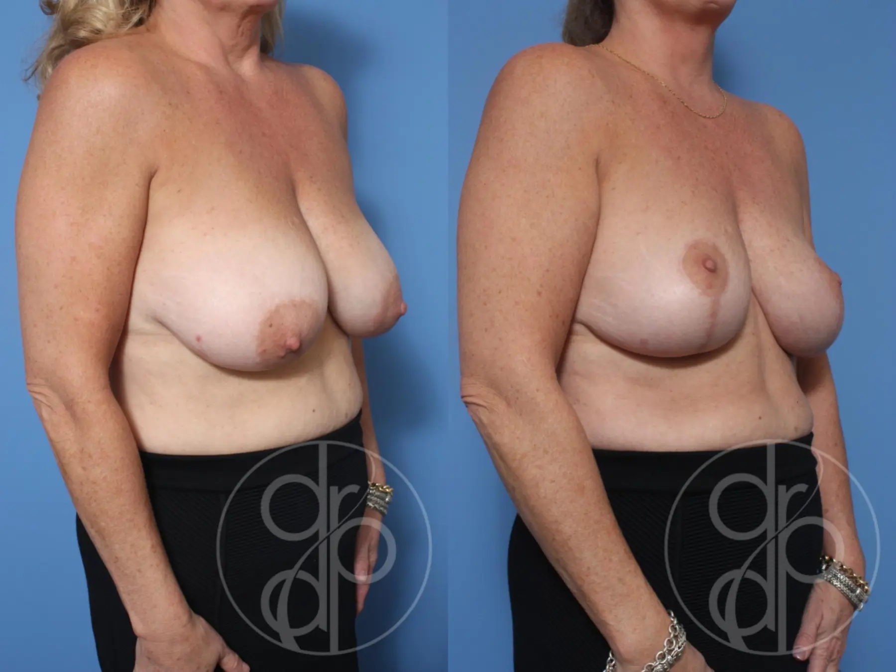 patient 10616 breast reduction before and after result - Before and After 3