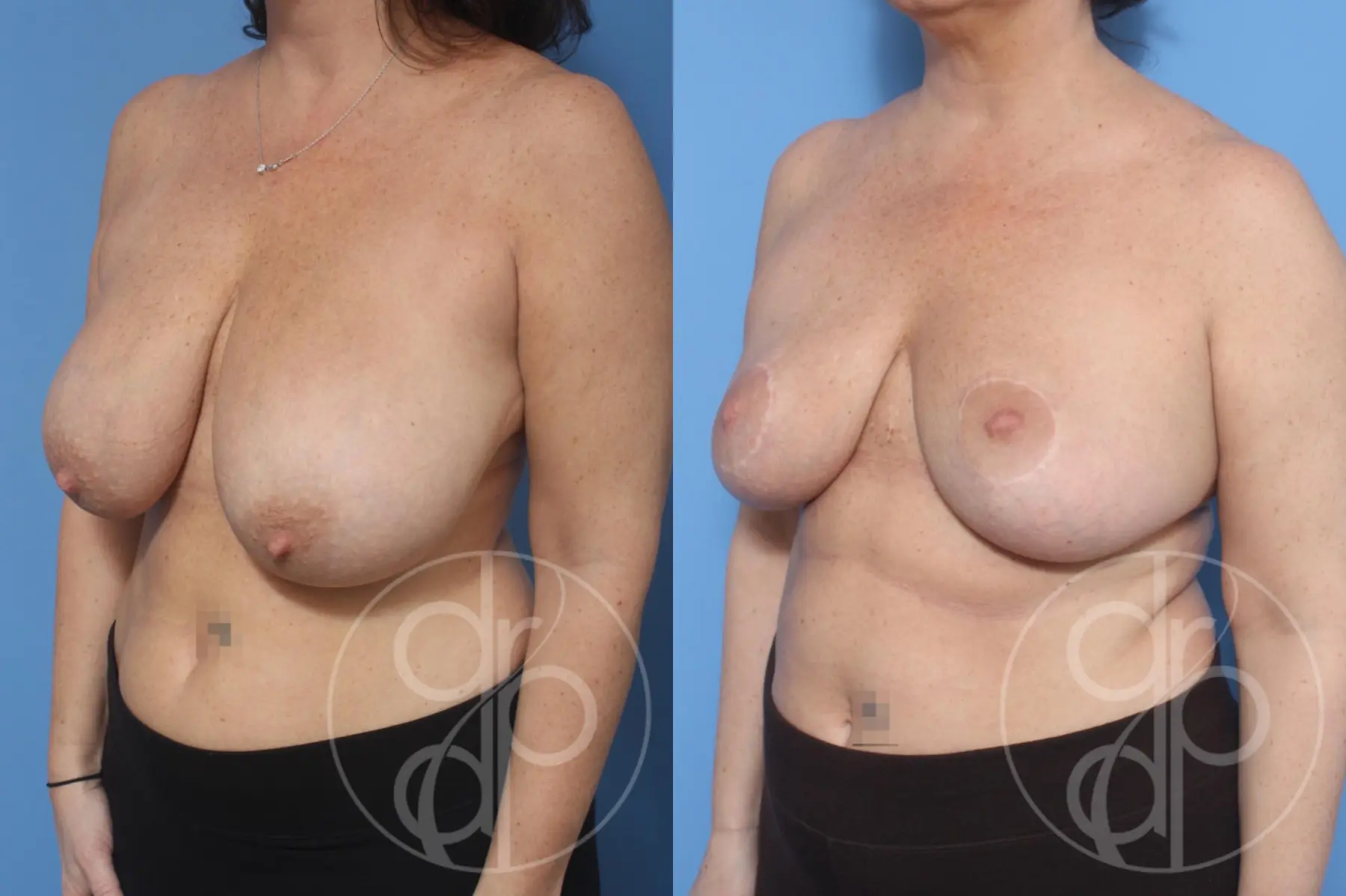 patient 12814 breast reduction before and after result - Before and After 2