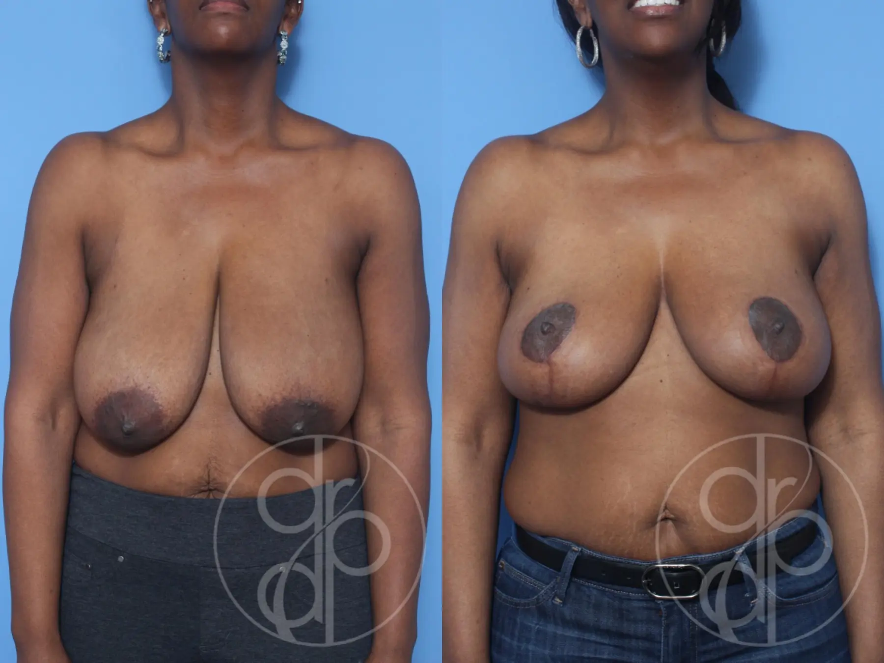 patient 13203 breast reduction before and after result - Before and After 1