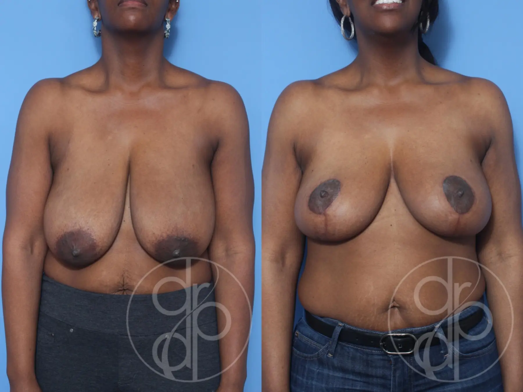 patient 13203 breast reduction before and after result - Before and After