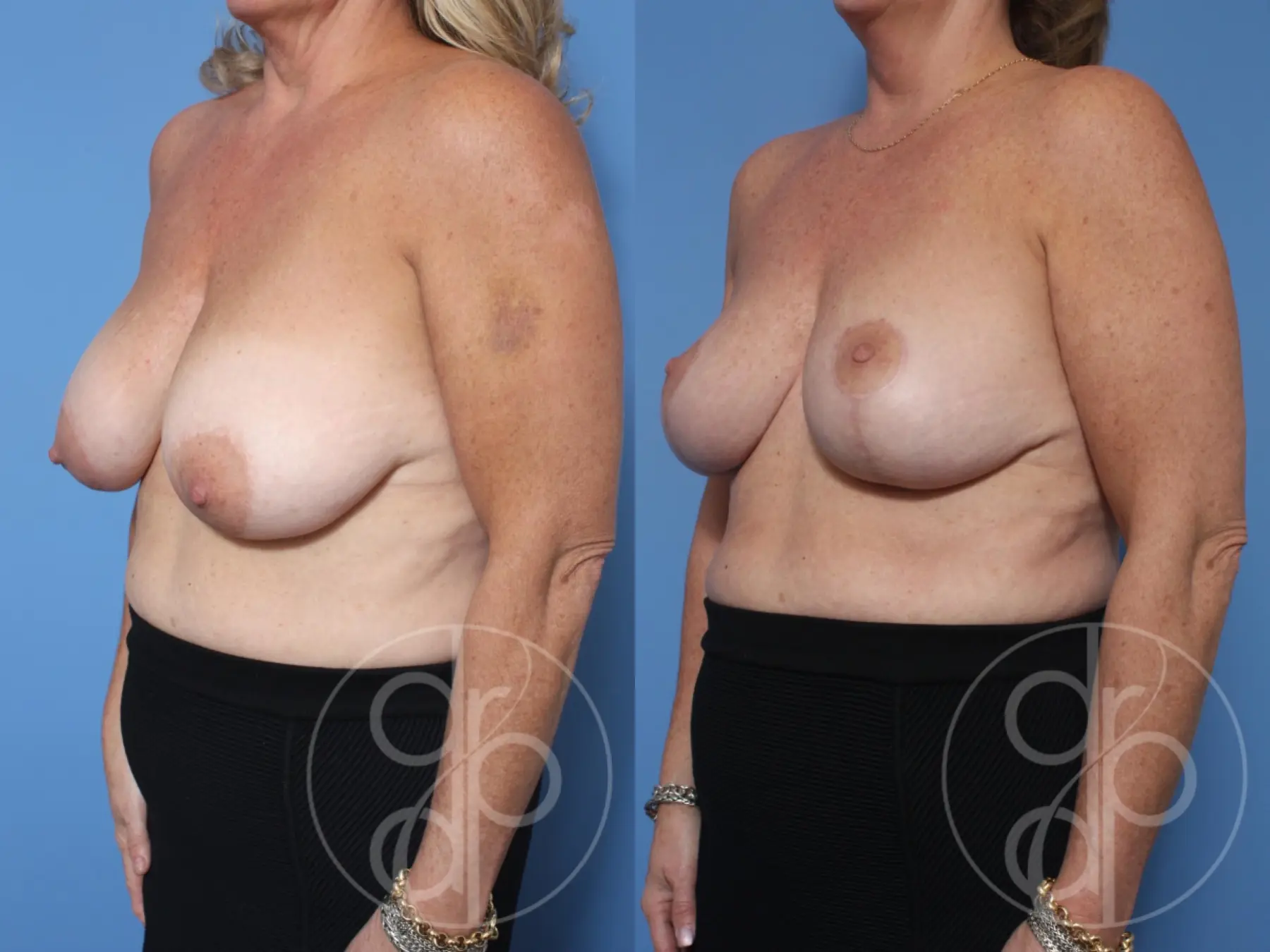 patient 10616 breast reduction before and after result - Before and After 2