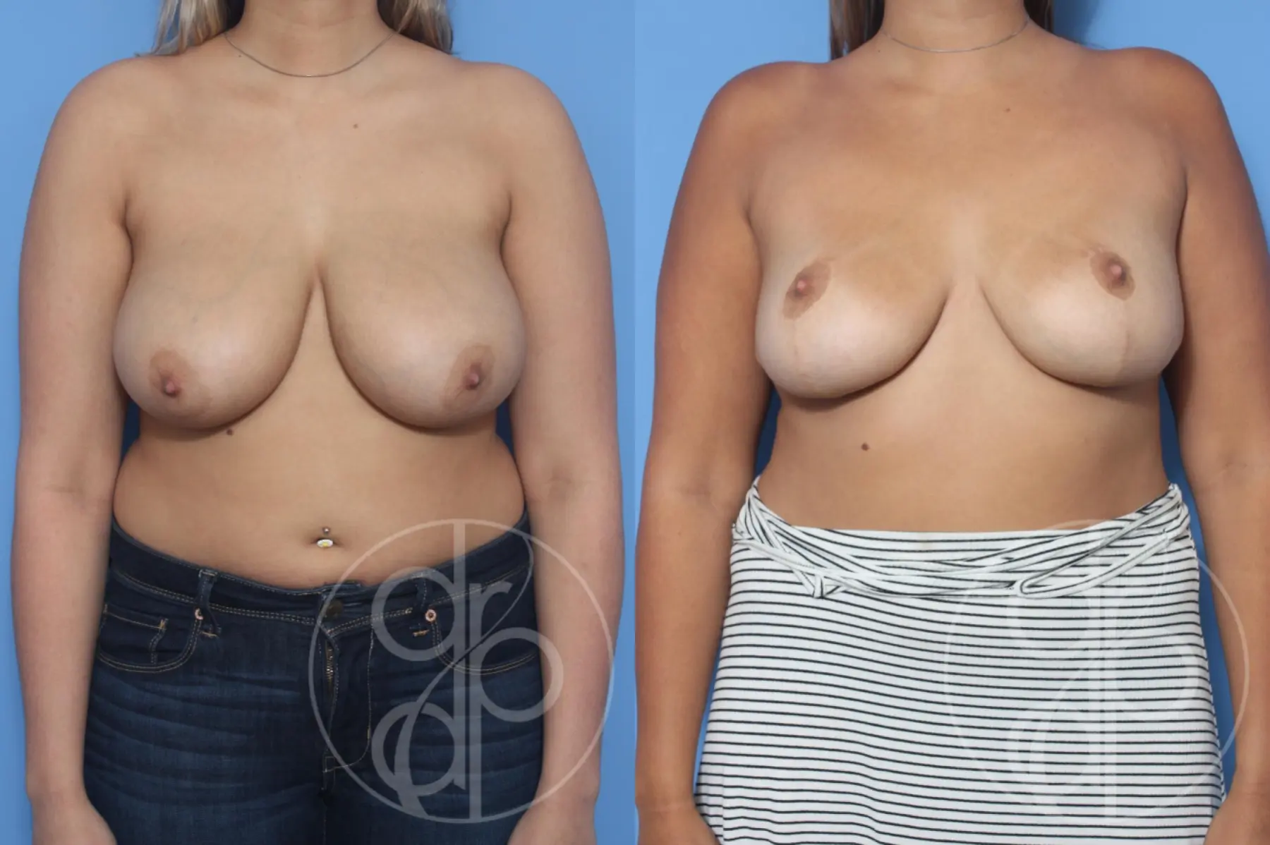 patient 13143 breast reduction before and after result - Before and After 1