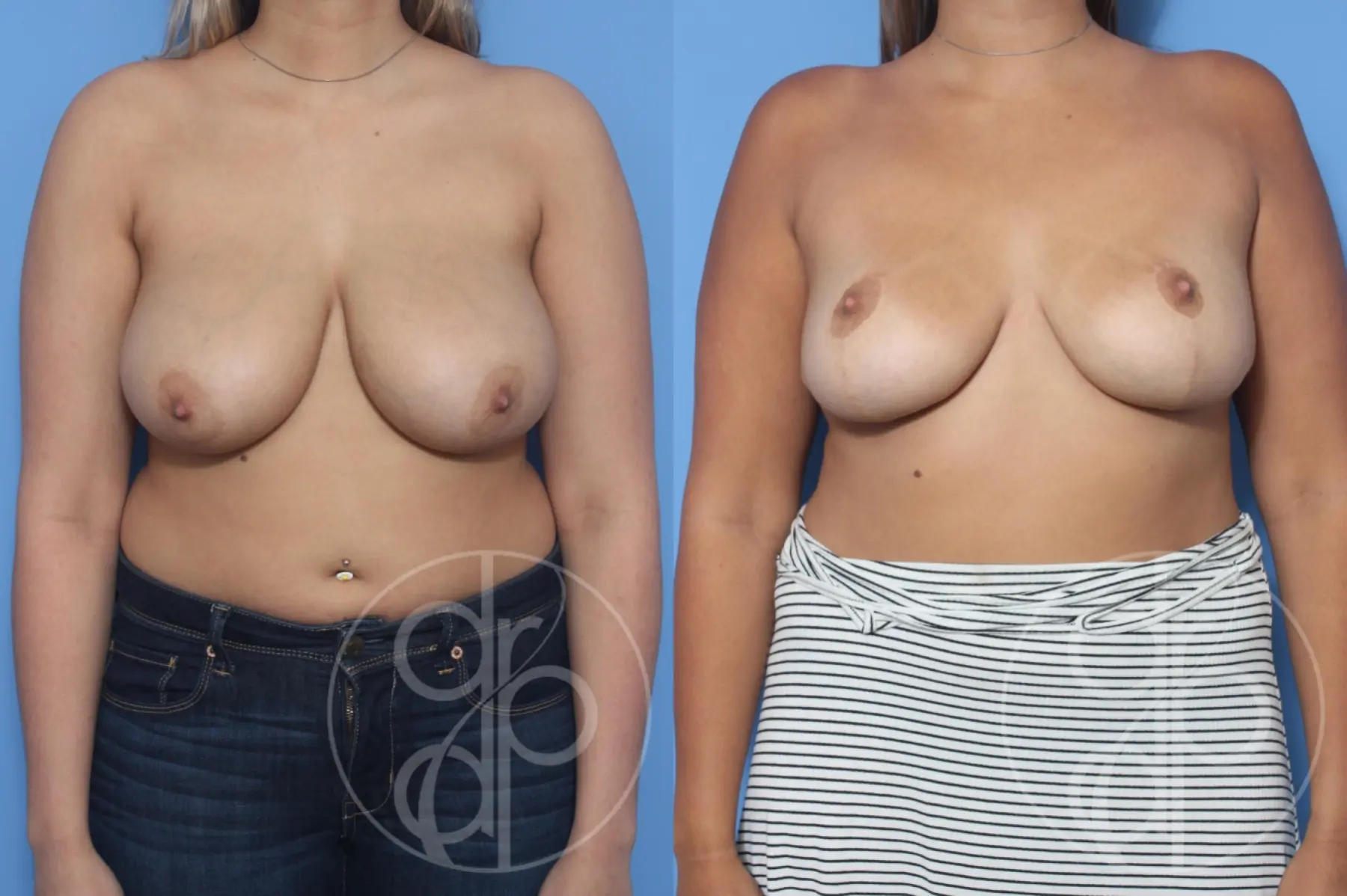 patient 13143 breast reduction before and after result - Before and After