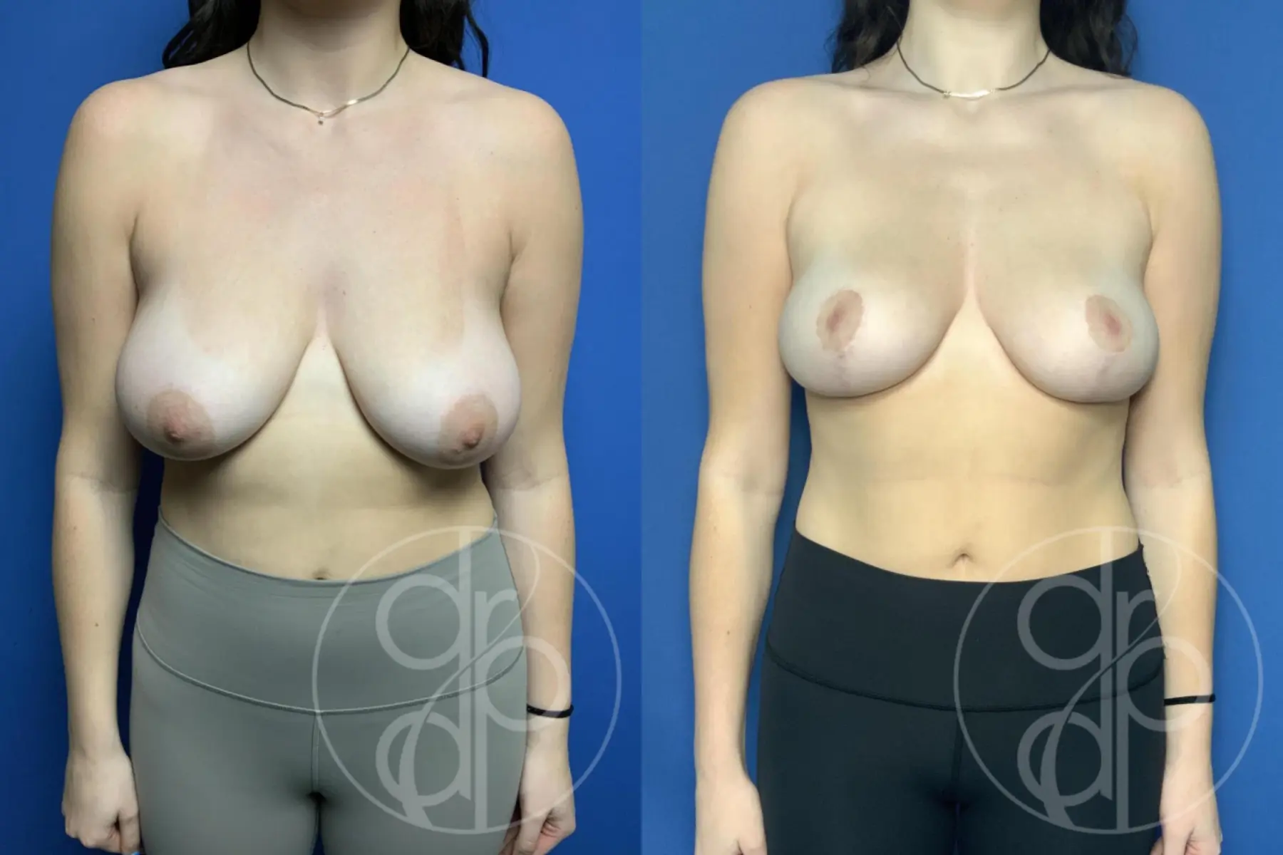 Breast Reduction: Patient 27 - Before and After 1